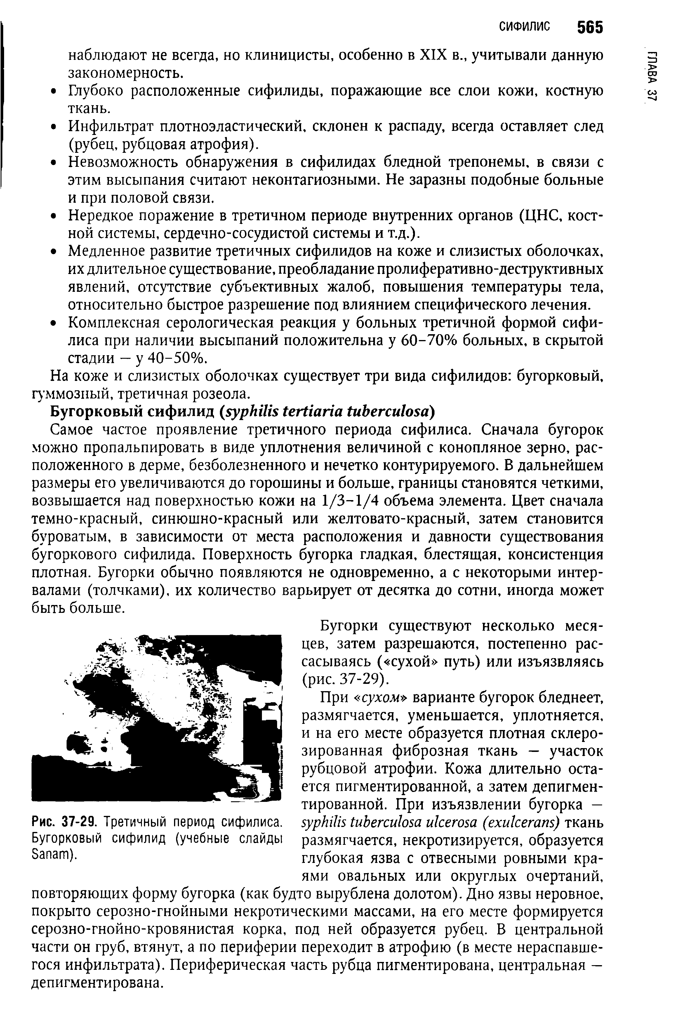 Рис. 37-29. Третичный период сифилиса. Бугорковый сифилид (учебные слайды Бапат).