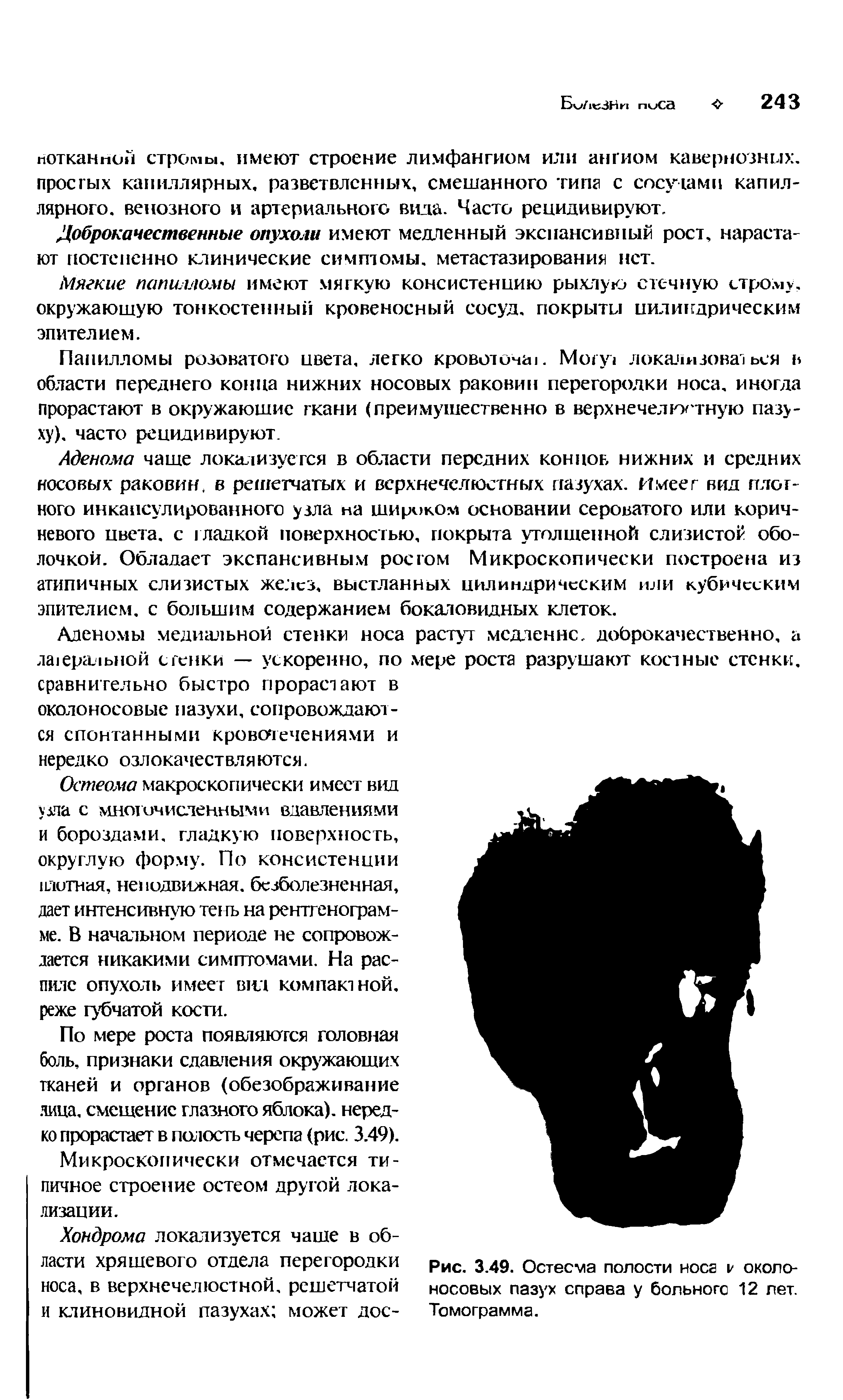 Рис. 3.49. Остеома полости носа к околоносовых пазух справа у больного 12 лет. Томограмма.