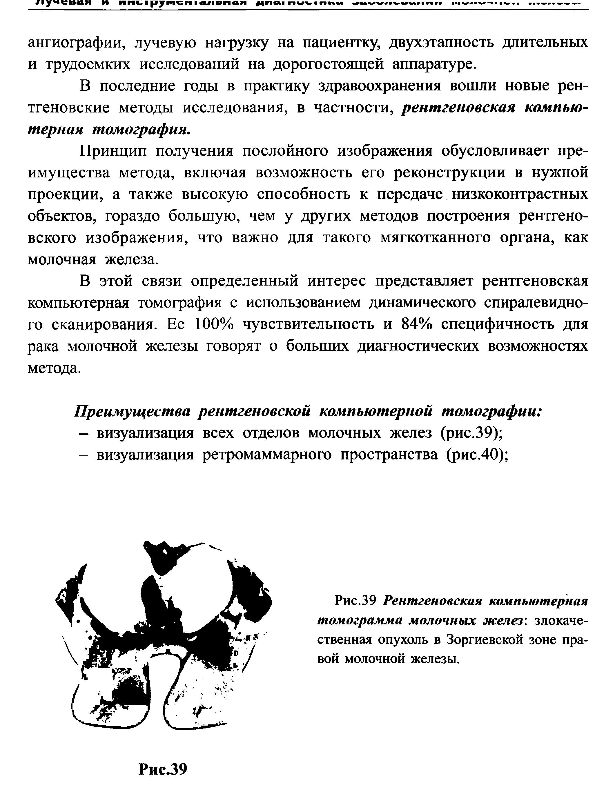 Рис.39 Рентгеновская компьютерная томограмма молочных желез злокачественная опухоль в Зоргиевской зоне правой молочной железы.