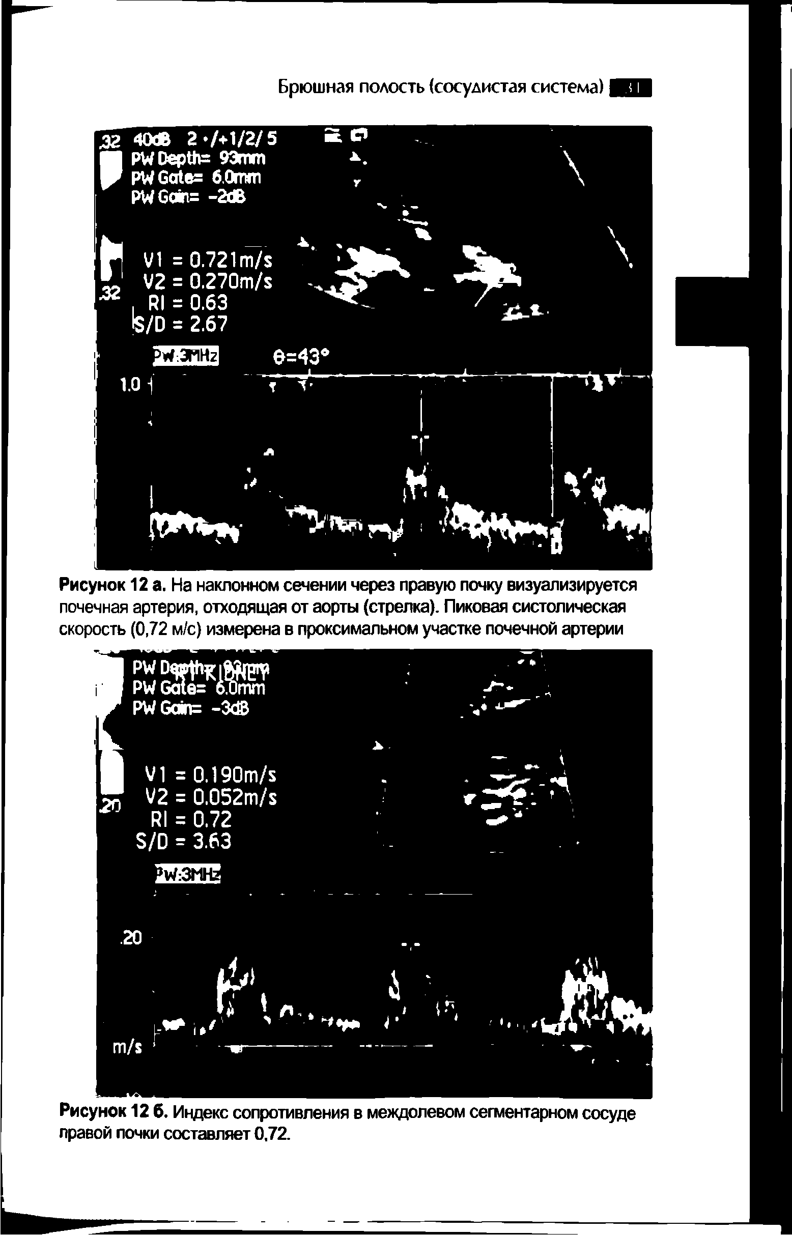 Рисунок 12 6. Индекс сопротивления в междолевом сегментарном сосуде правой почки составляет 0,72.