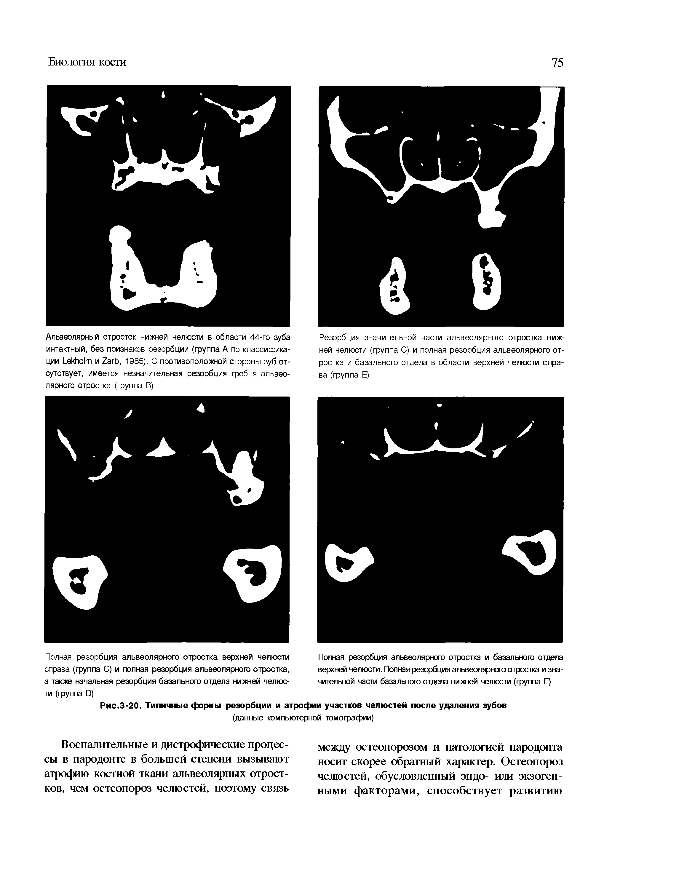 Рис.3-20. Типичные формы резорбции и атрофии участков челюстей после удаления зубов...