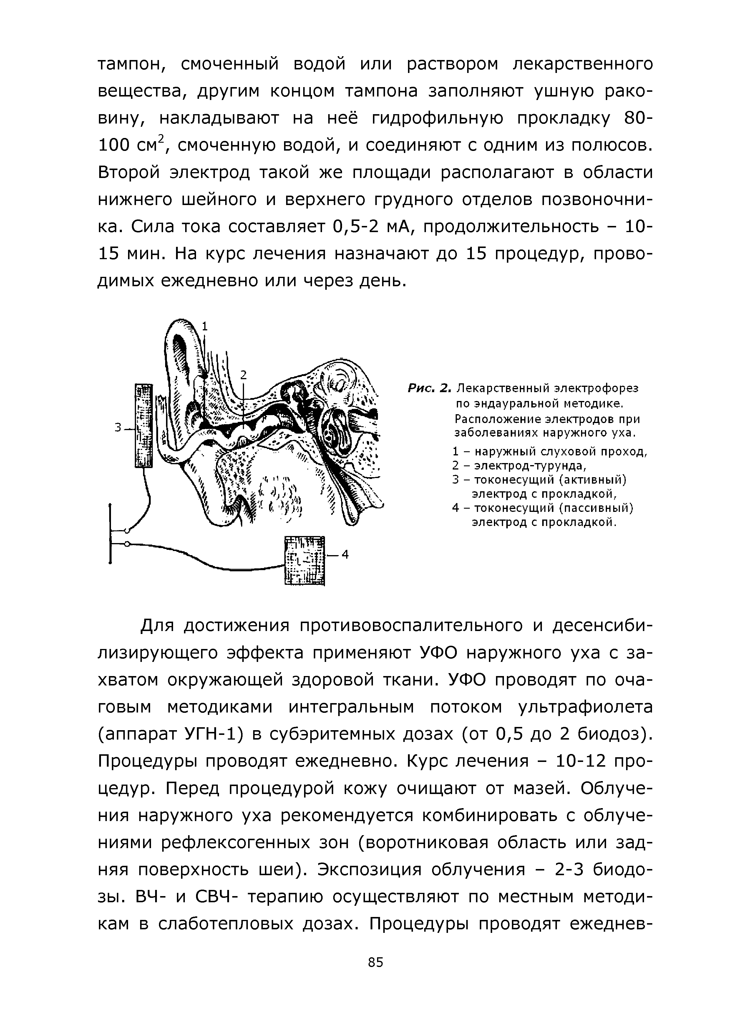 Рис. 2. Лекарственный электрофорез по эндауральной методике. Расположение электродов при заболеваниях наружного уха.