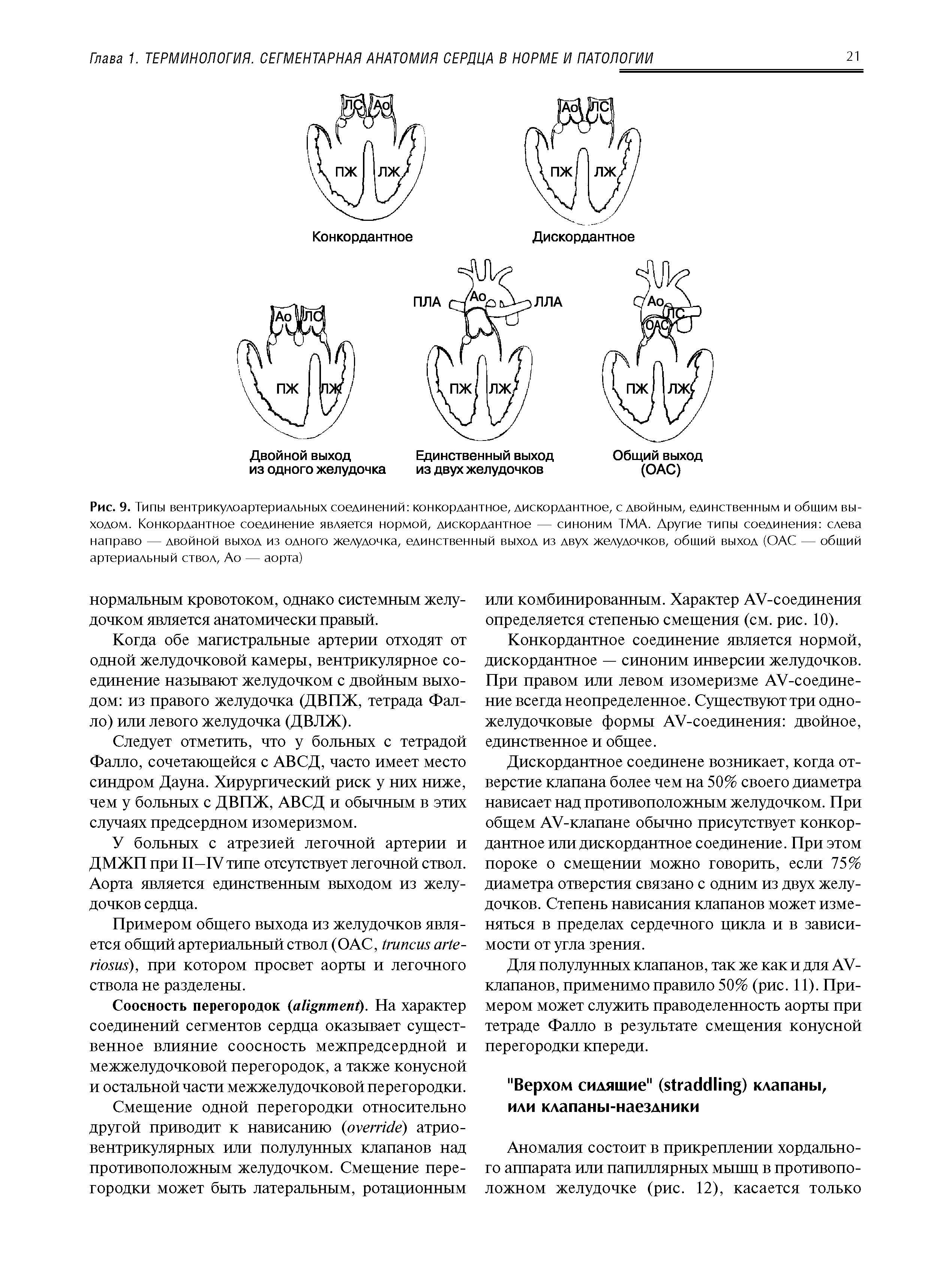 Рис. 9. Типы вентрикулоартериальных соединений конкордантное, дискордантное, с двойным, единственным и общим выходом. Конкордантное соединение является нормой, дискордантное — синоним ТМА. Другие типы соединения слева направо — двойной выход из одного желудочка, единственный выход из двух желудочков, общий выход (ОАС — общий артериальный ствол, Ао — аорта)...