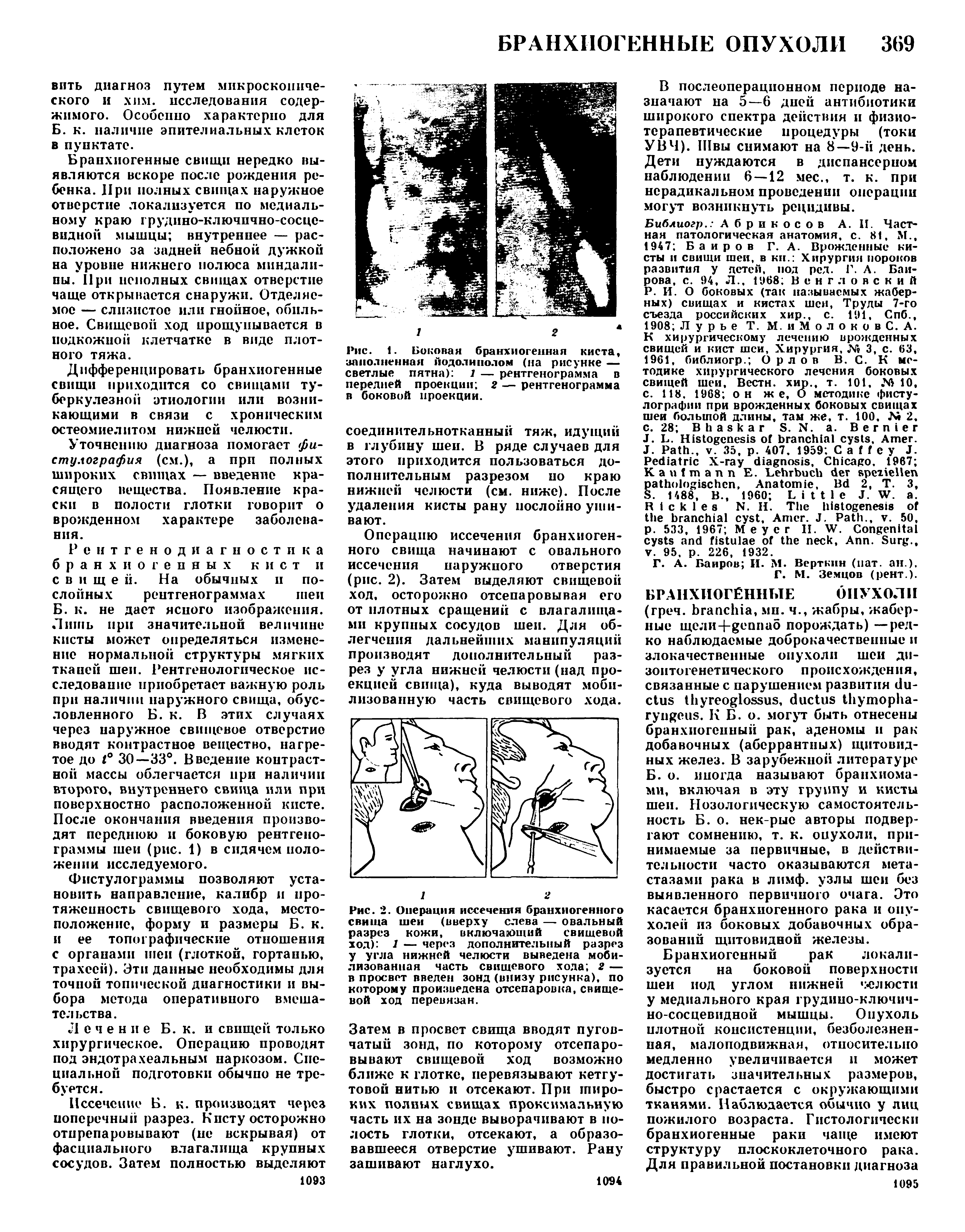 Рис. 1. Боковая бранхиогенная киста, заполненная иодолиполом (на рисунке — светлые пятна) 1 — рентгенограмма в передней проекции 2 — рентгенограмма в боковой проекции.