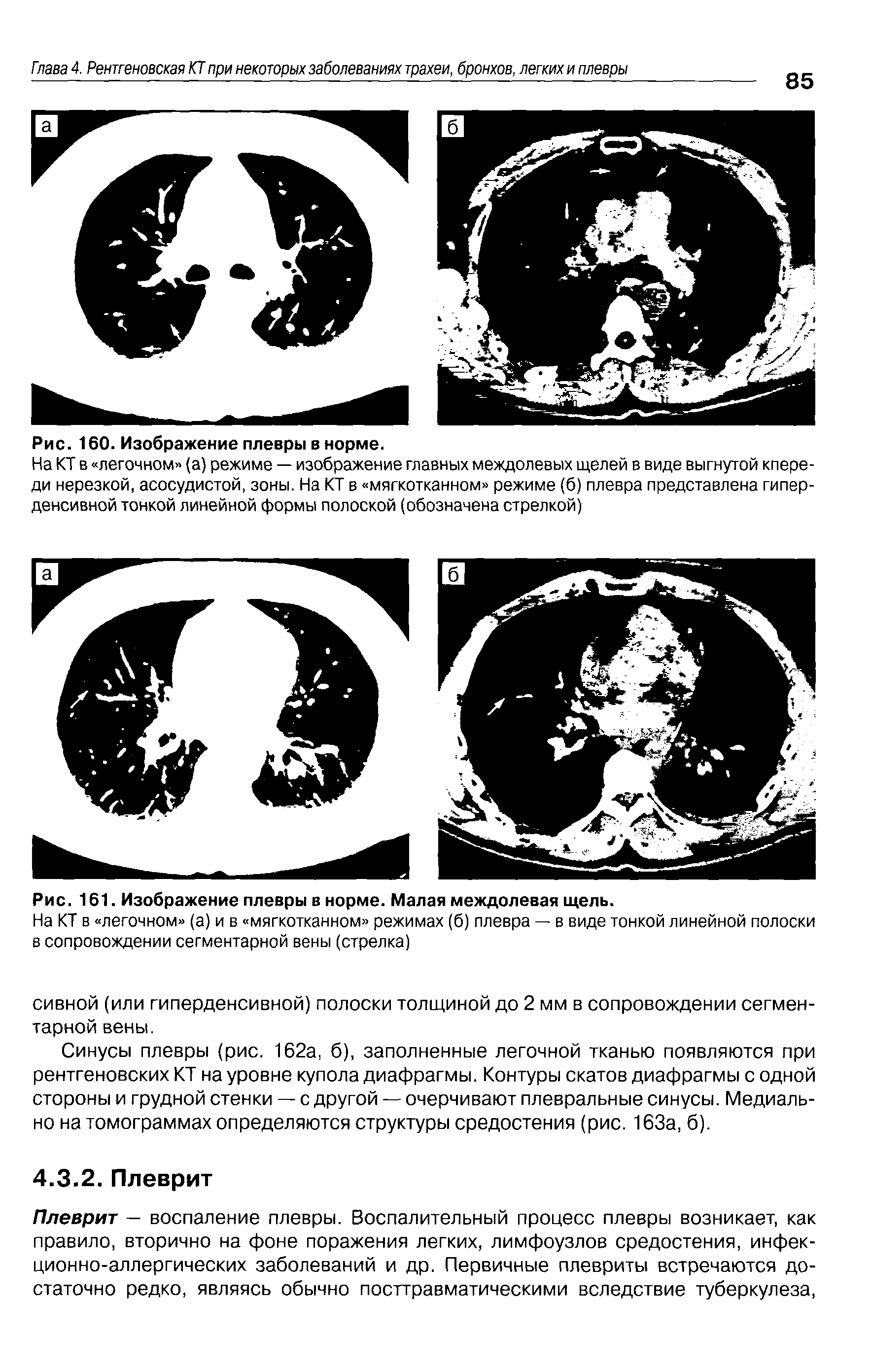 Рис. 161. Изображение плевры в норме. Малая междолевая щель.