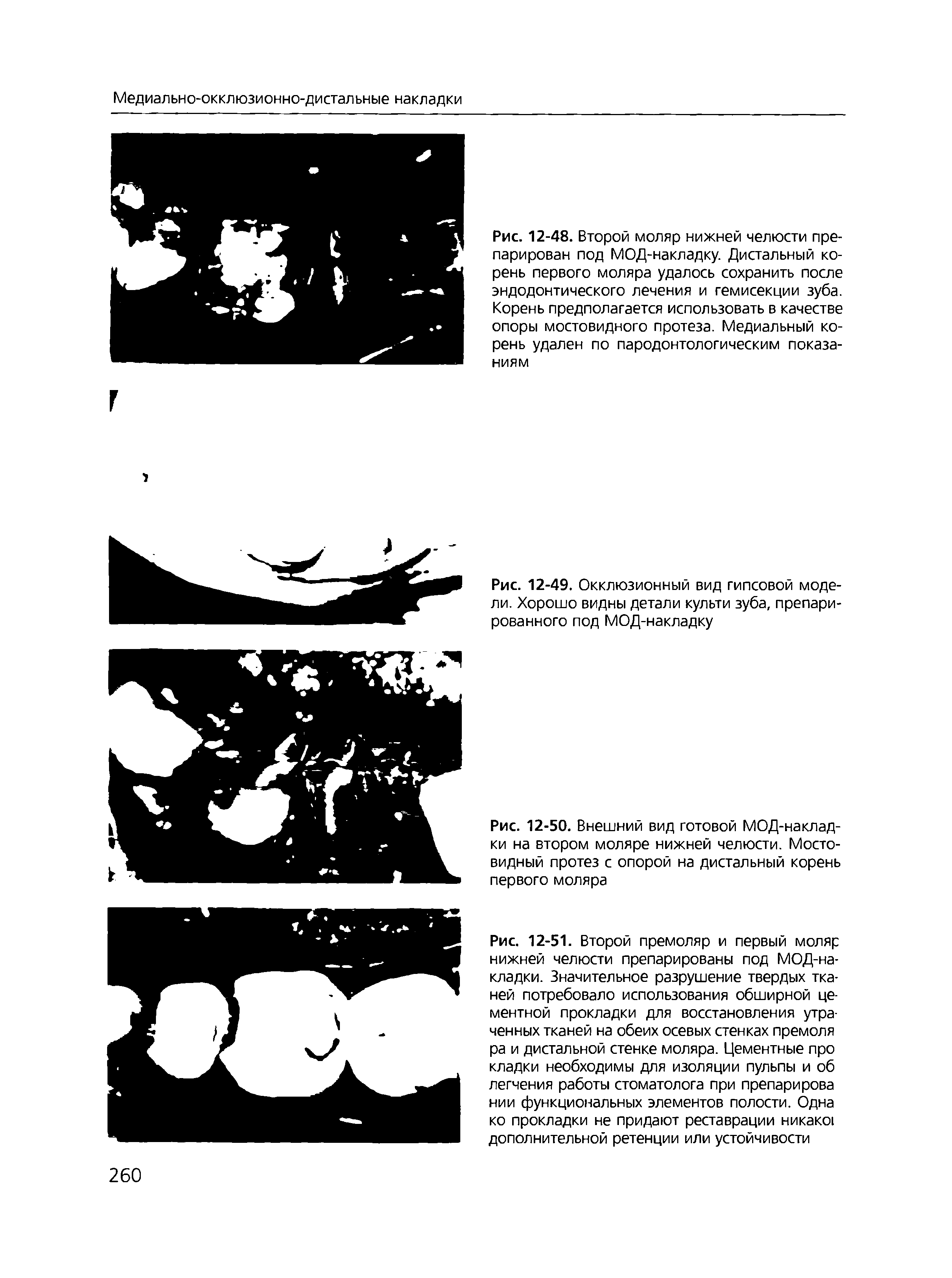 Рис. 12-48. Второй моляр нижней челюсти препарирован под МОД-накладку. Дистальный корень первого моляра удалось сохранить после эндодонтического лечения и гемисекции зуба. Корень предполагается использовать в качестве опоры мостовидного протеза. Медиальный корень удален по пародонтологическим показаниям...