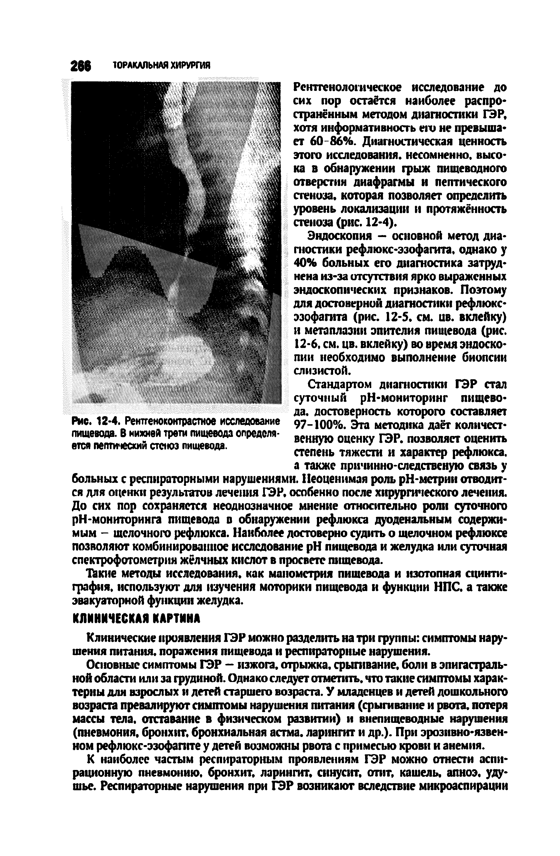 Рис. 12 4. Рентгеноконтрастное исследование пищевода. В нижней трети пищевода определяется пептический стеноз пищевода.