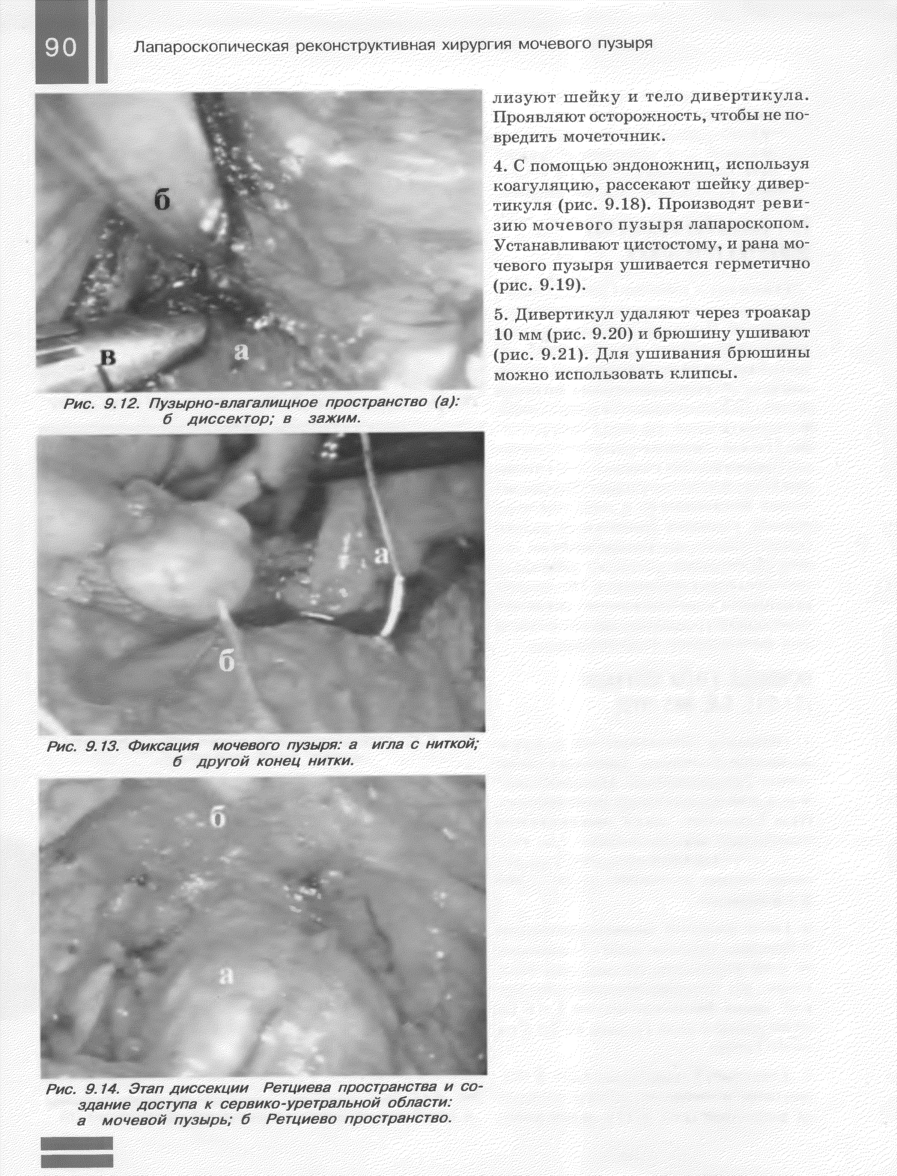 Рис. 9.14. Этап диссекции Ретциева пространства и создание доступа к сервико-уретральной области а мочевой пузырь б Ретциево пространство.