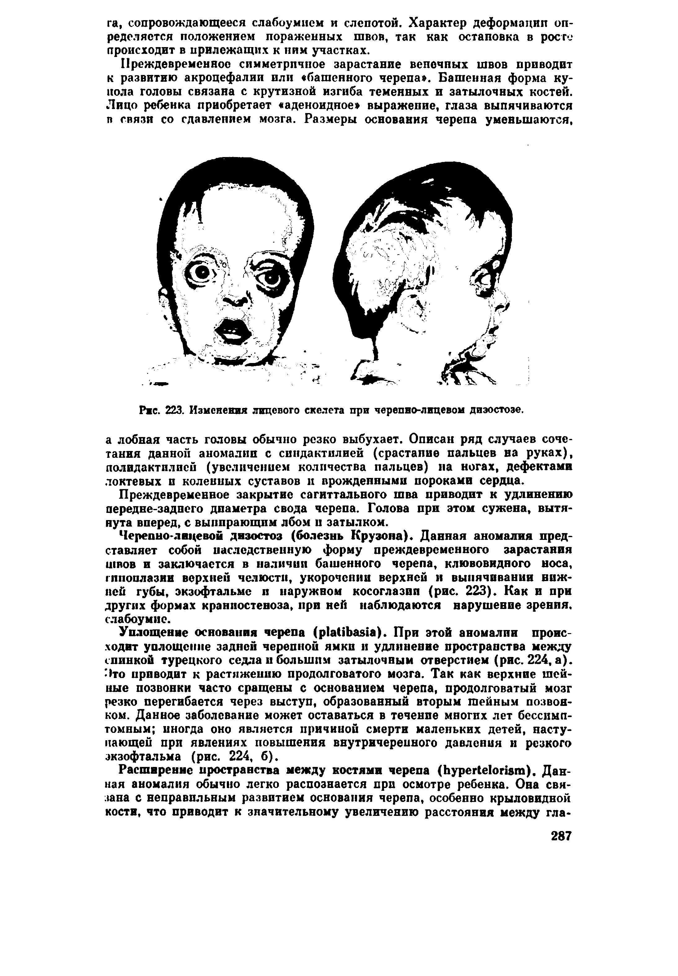Рис. 223. Изменения лицевого скелета при черепно-лицевом дизостозе.