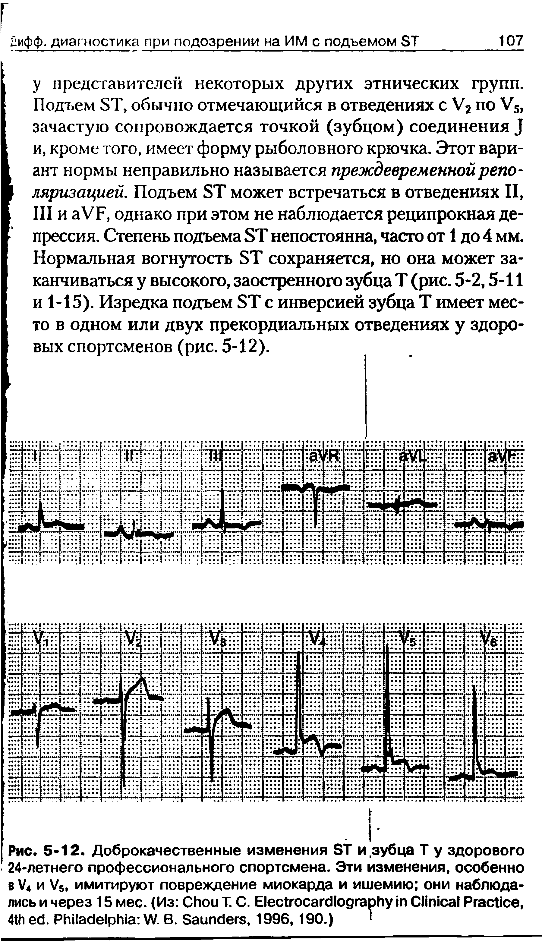 Рис. 5-12. Доброкачественные изменения ST и зубца Т у здорового 24-летнего профессионального спортсмена. Эти изменения, особенно в V4 и V5, имитируют повреждение миокарда и ишемию они наблюдались и через 15 мес. (Из C Т. С. E C P , 4 . P W. B. S , 1996,190.) ...