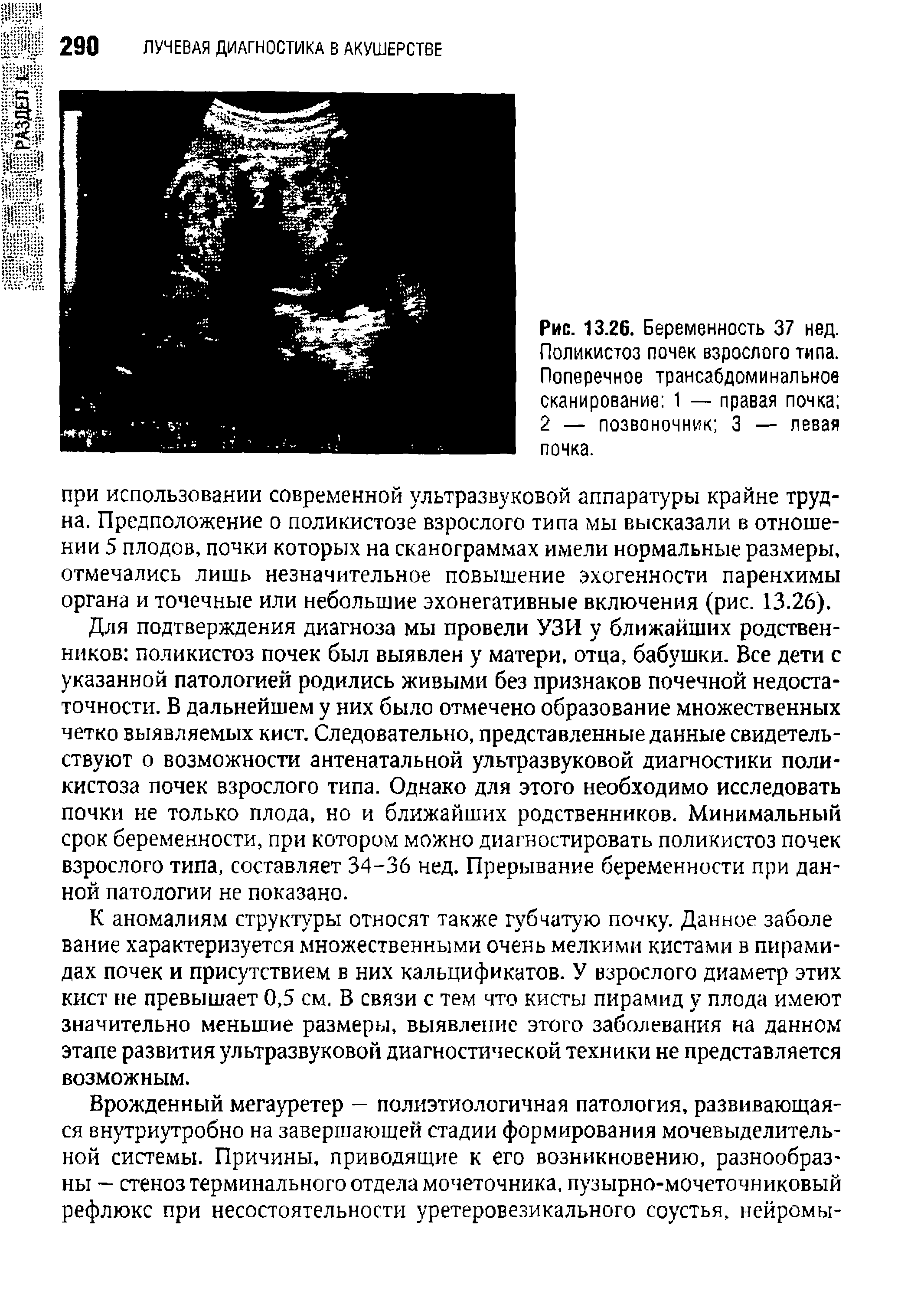 Рис. 13.26. Беременность 37 нед. Поликистоз почек взрослого типа. Поперечное трансабдоминальное сканирование 1 — правая почка 2 — позвоночник 3 — левая почка.