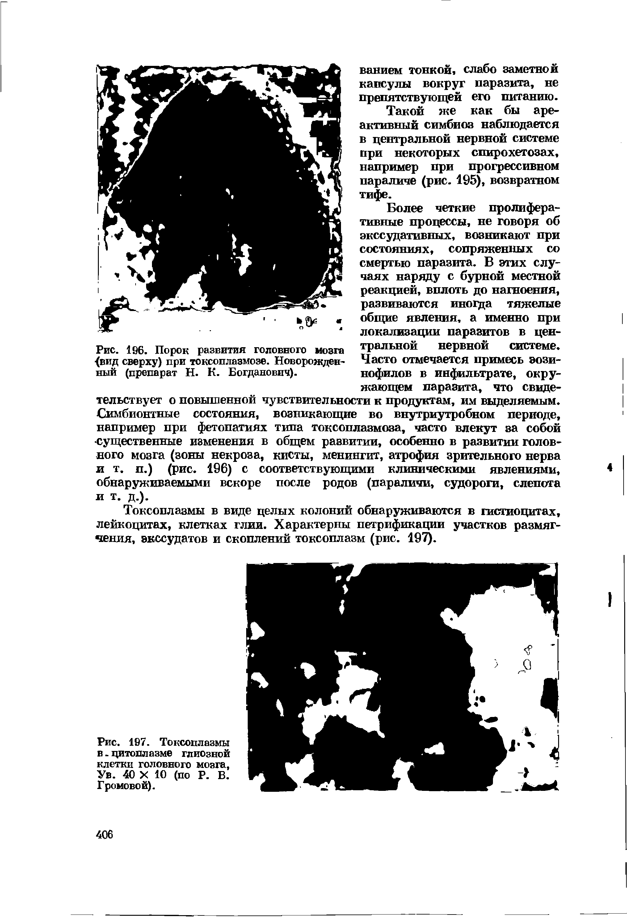 Рис. 196. Порок развития головного мозга (вид сверху) при токсоплазмозе. Новорожденный (препарат Н. К. Богданович).