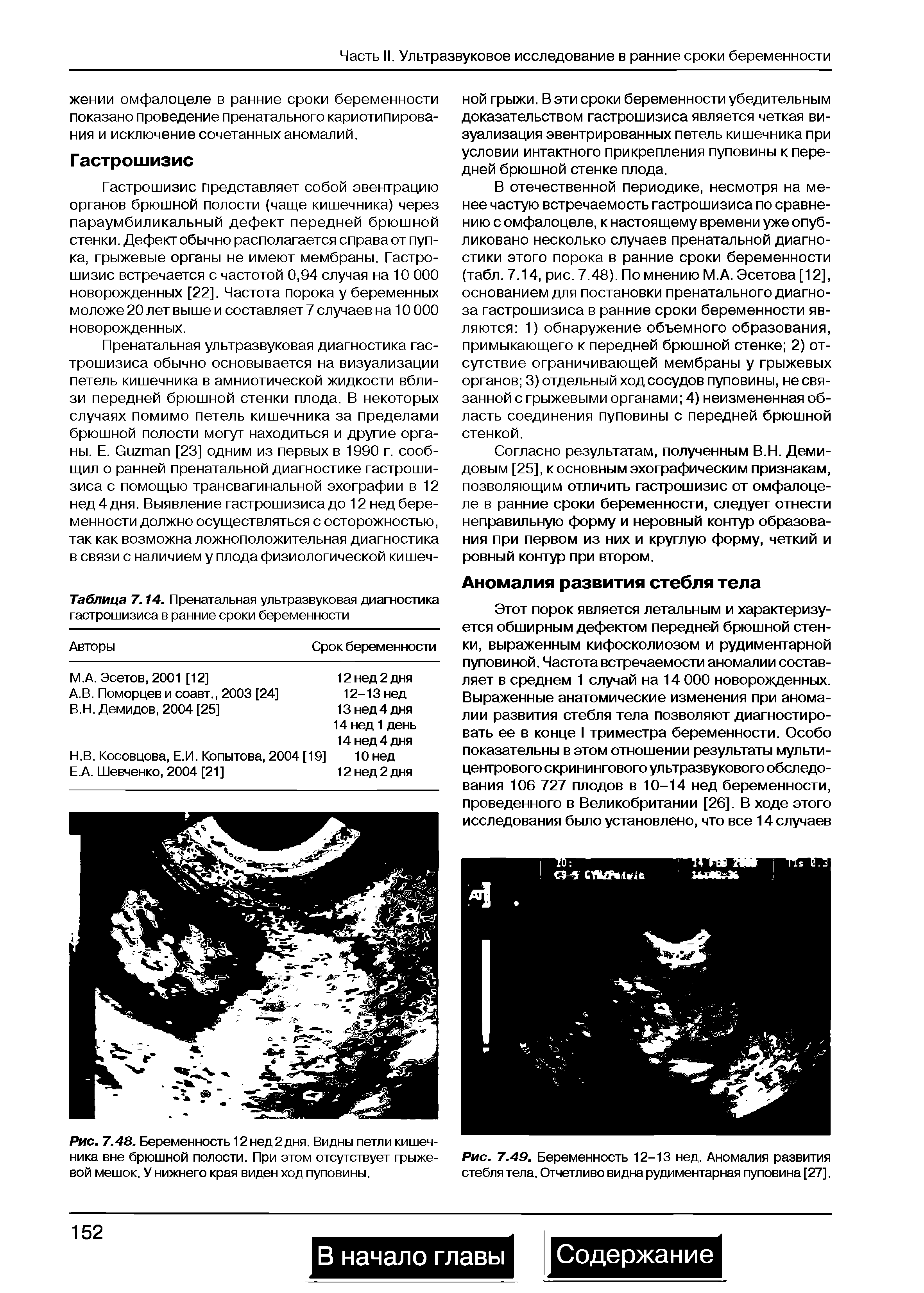 Рис. 7.49. Беременность 12-13 нед. Аномалия развития стебля тела. Отчетливо видна рудиментарная пуповина [27].