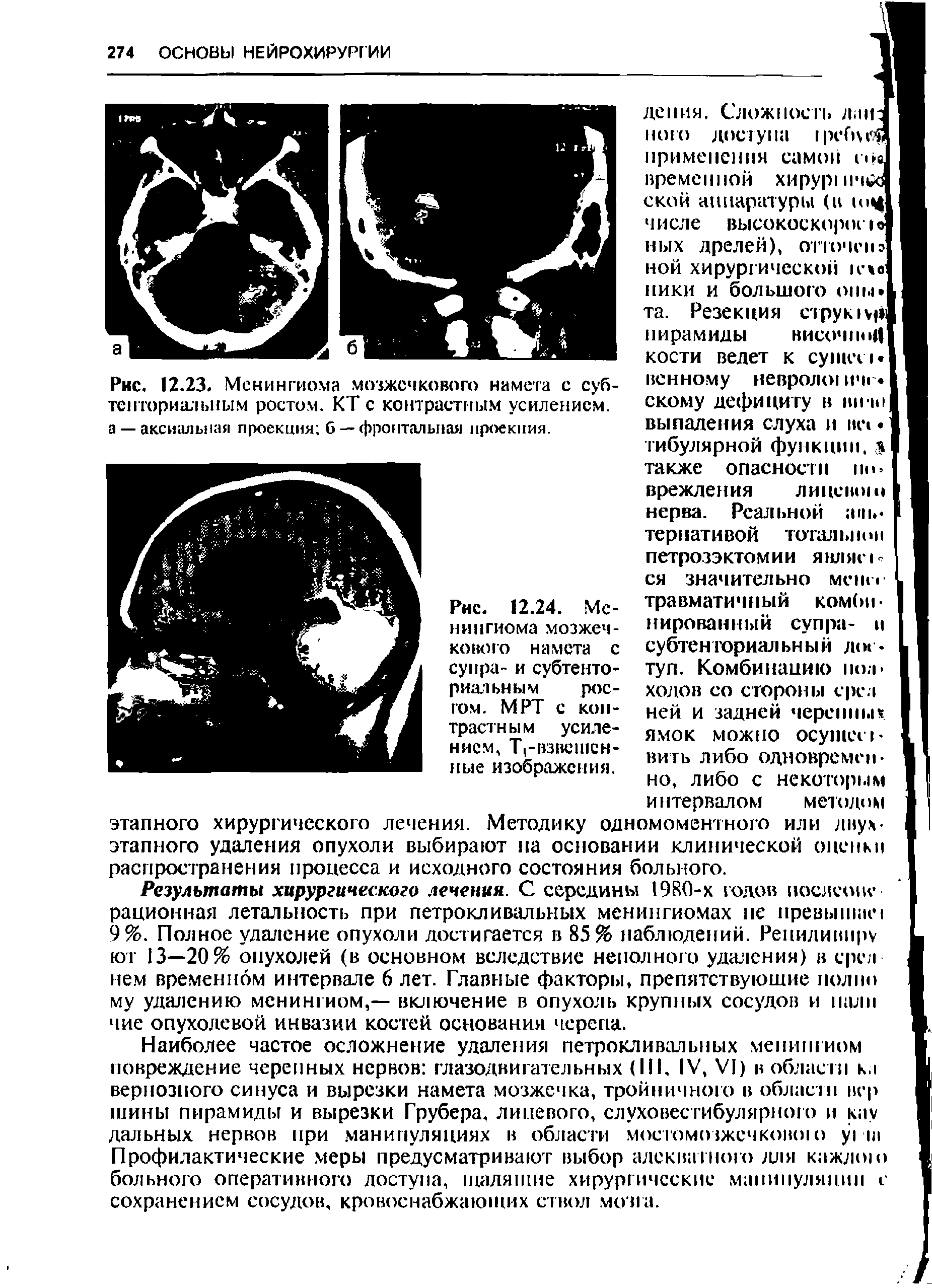 Рис. 12.23. Менингиома мозжечкового намета с субтенториальным ростом. КТ с контрастным усилением, а — аксиальная проекция б — фронтальная проекция.