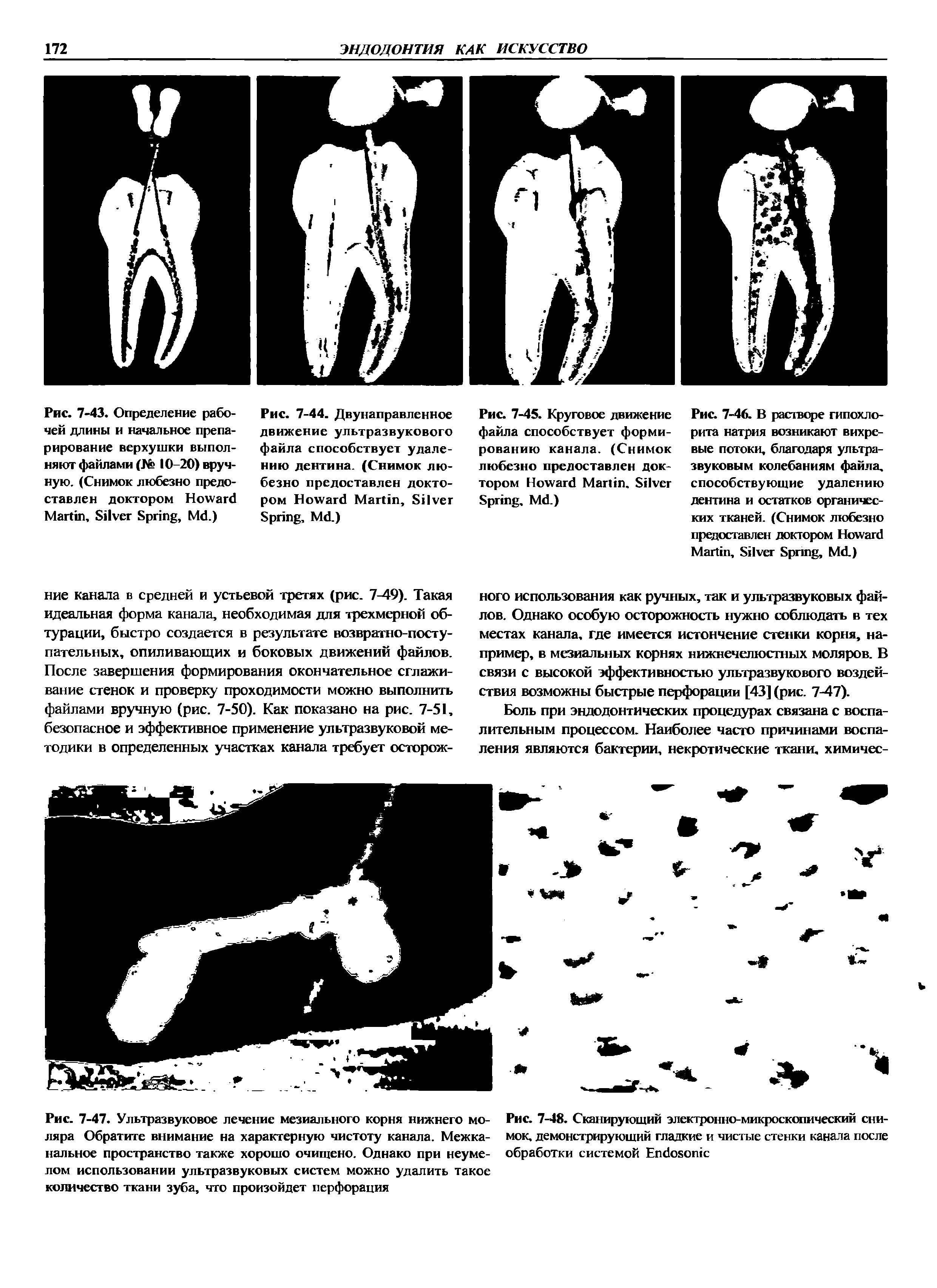 Рис. 7-47. Ультразвуковое лечение мезиального корня нижнего моляра Обратите внимание на характерную чистоту канала. Межканальное пространство также хорошо очищено. Однако при неумелом использовании ультразвуковых систем можно удалить такое количество ткани зуба, что произойдет перфорация...