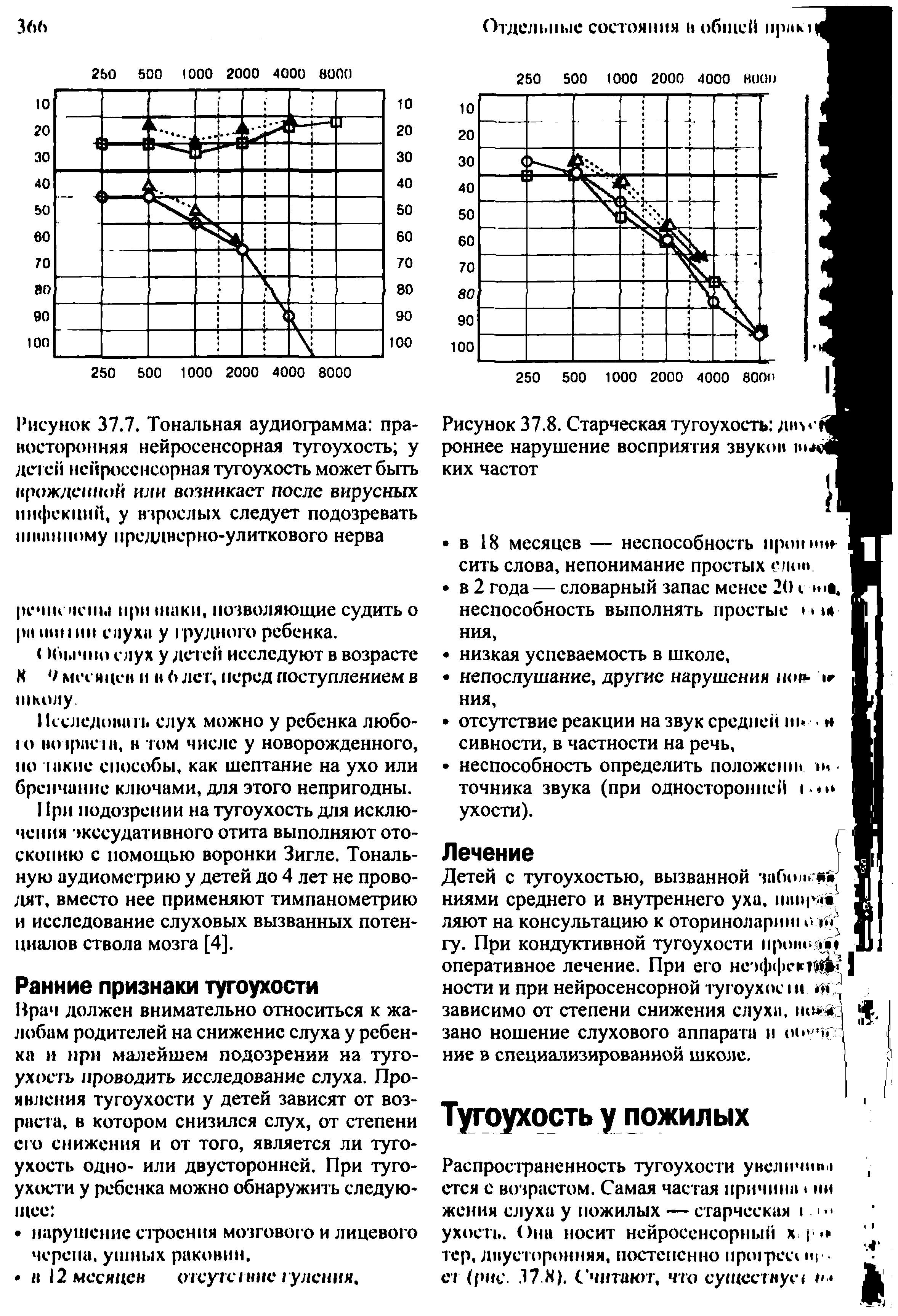 Рисунок 37.7. Тональная аудиограмма правосторонняя нейросенсорная тугоухость у детей нейросенсорная тугоухость может быть врожденной или возникает после вирусных инфекций, у взрослых следует подозревать шванному преддверно-улиткового нерва...