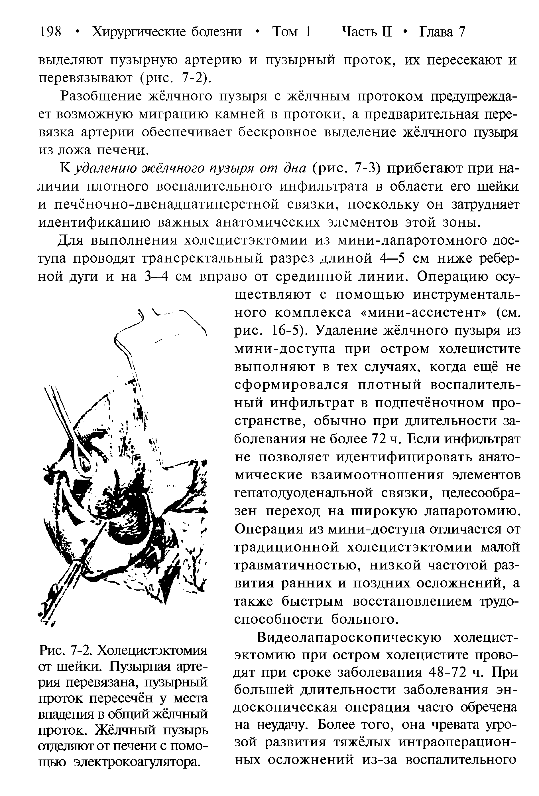 Рис. 7-2. Холецистэктомия от шейки. Пузырная артерия перевязана, пузырный проток пересечён у места впадения в общий жёлчный проток. Жёлчный пузырь отделяют от печени с помощью электрокоагулятора.