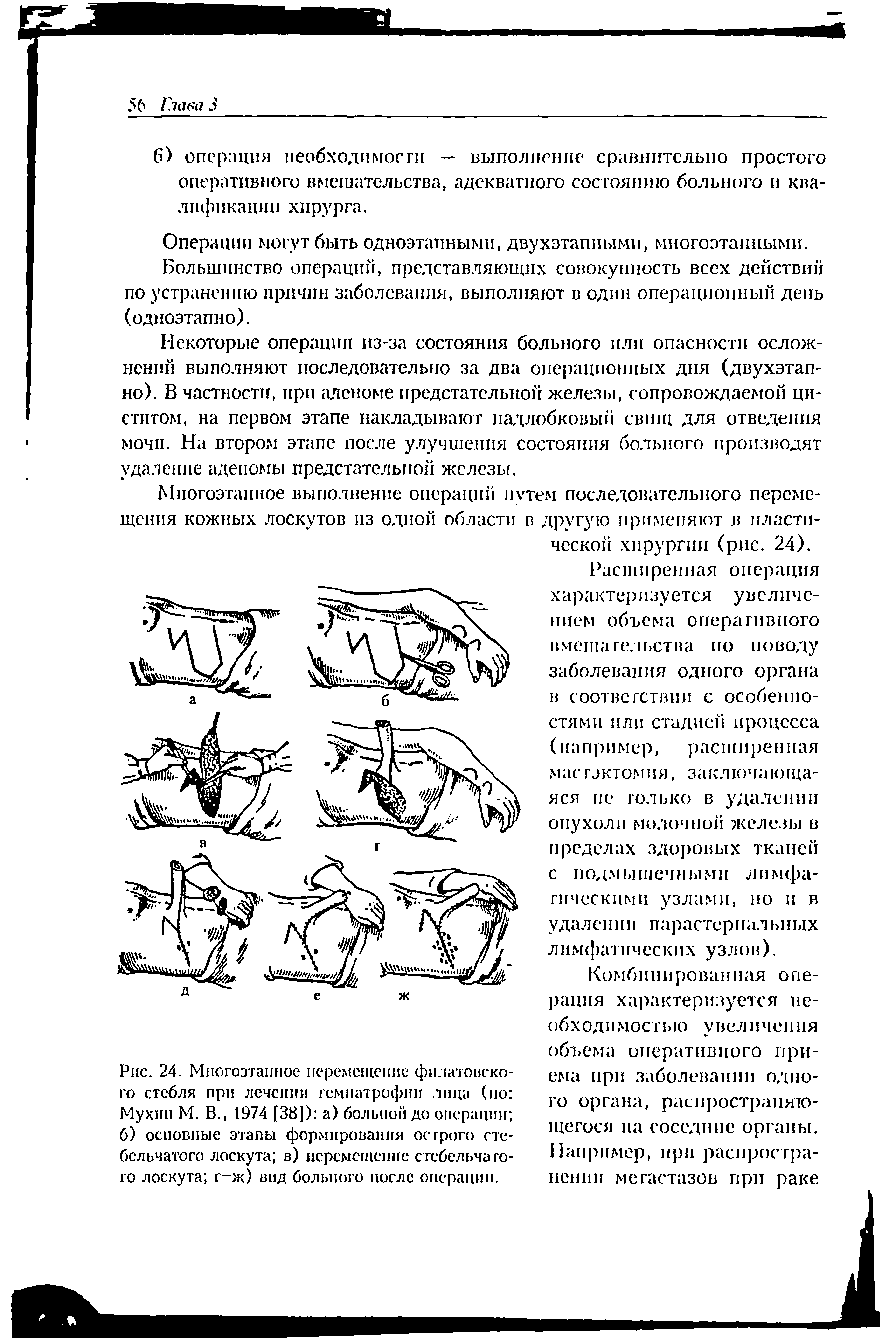 Рис. 24. Многоэтапное перемещение физатовско-го стебля при лечении гемиатрофии лица (по Мухин М. В., 1974 [381) а) больной до операции б) основные этапы формирования острого стебельчатого лоскута в) перемещение стебельчатого лоскута г-ж) вид больного после операции.