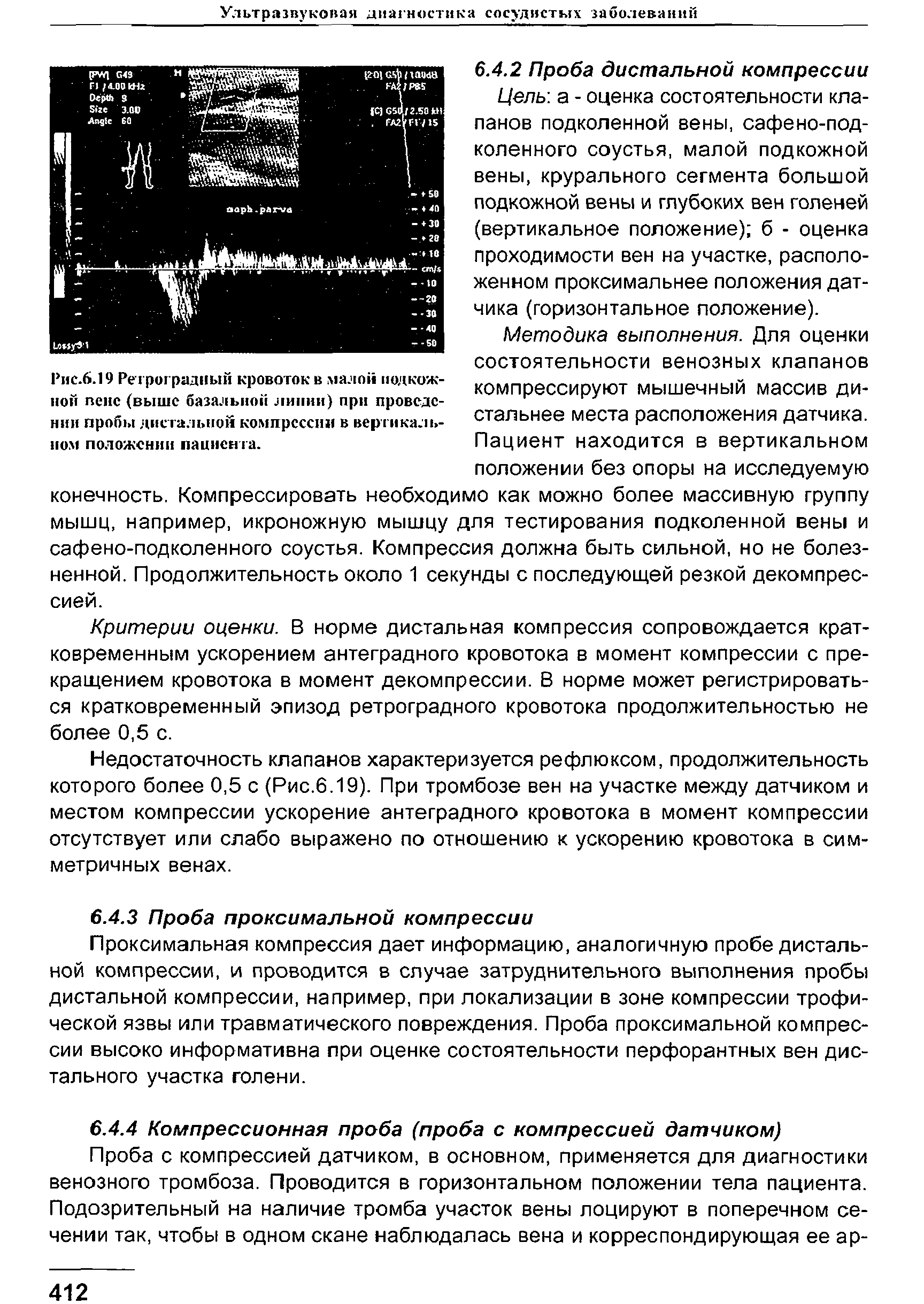 Рис.6.19 Ре троградный кровоток в малой подкожной пенс (выше базальной липни) при проведении пробы дистальной компрессии в вертикальном положении пациента.