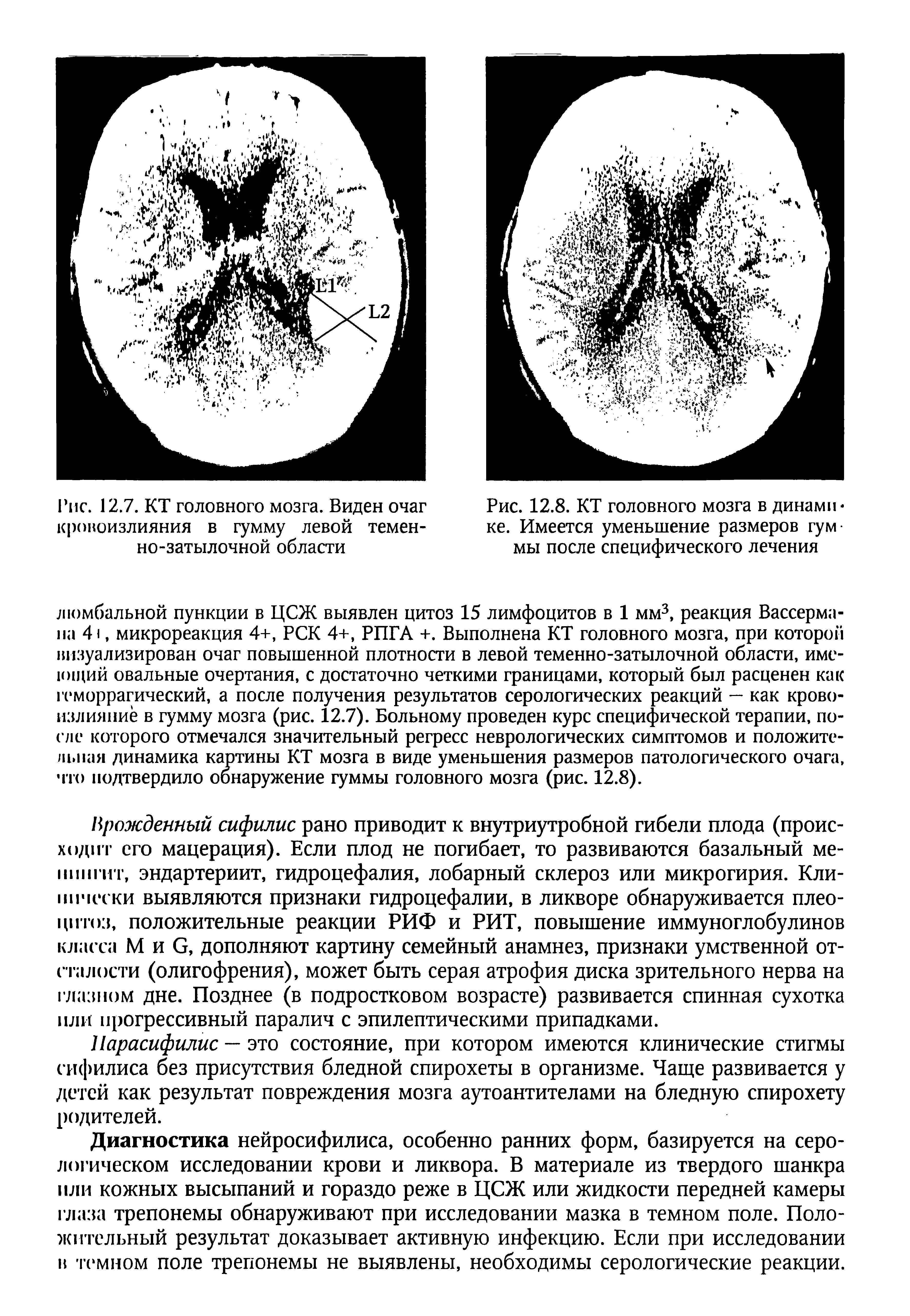 Рис. 12.7. КТ головного мозга. Виден очаг кровоизлияния в гумму левой теменно-затылочной области...