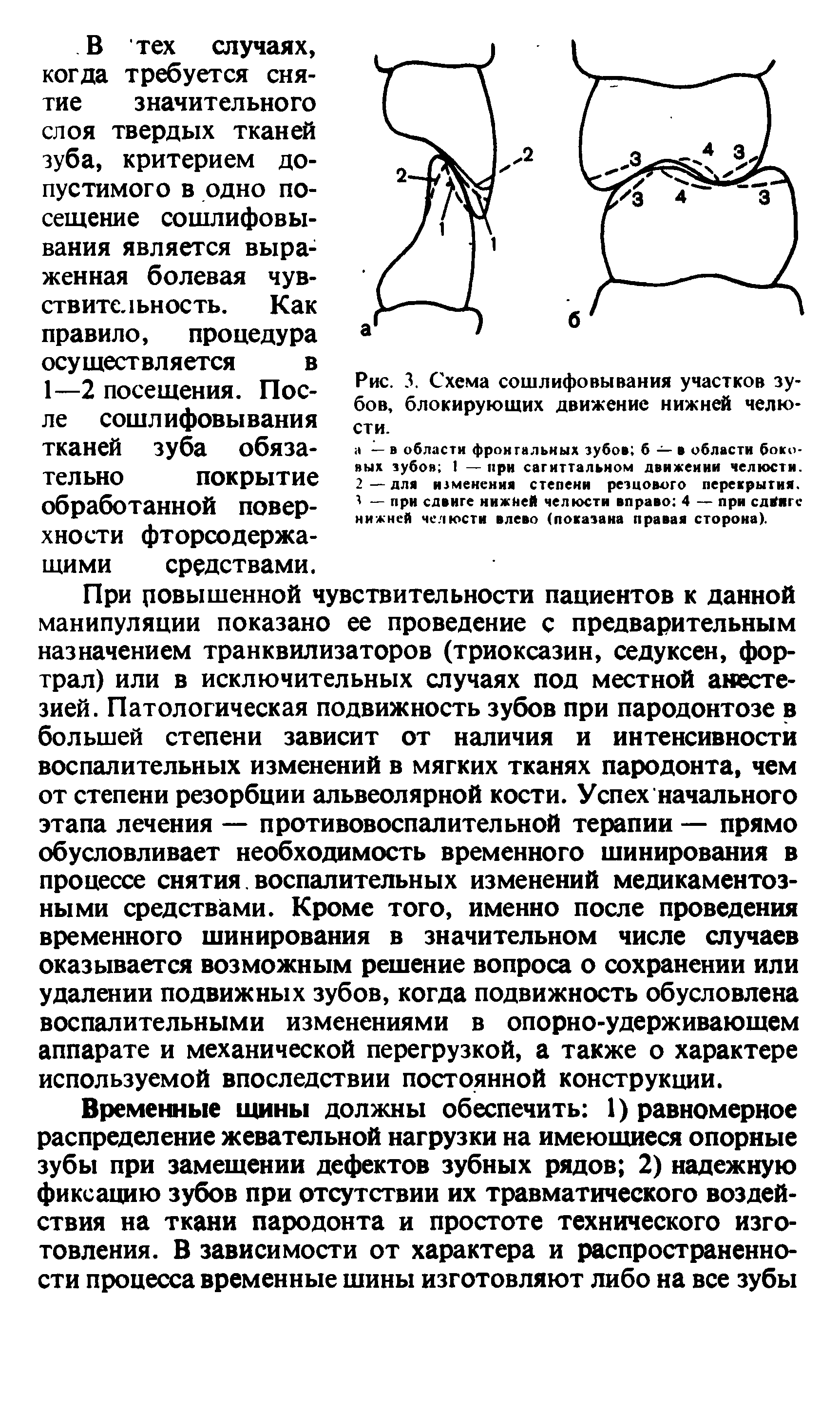 Рис. 3. Схема сошлифовывания участков зубов, блокирующих движение нижней челюсти.