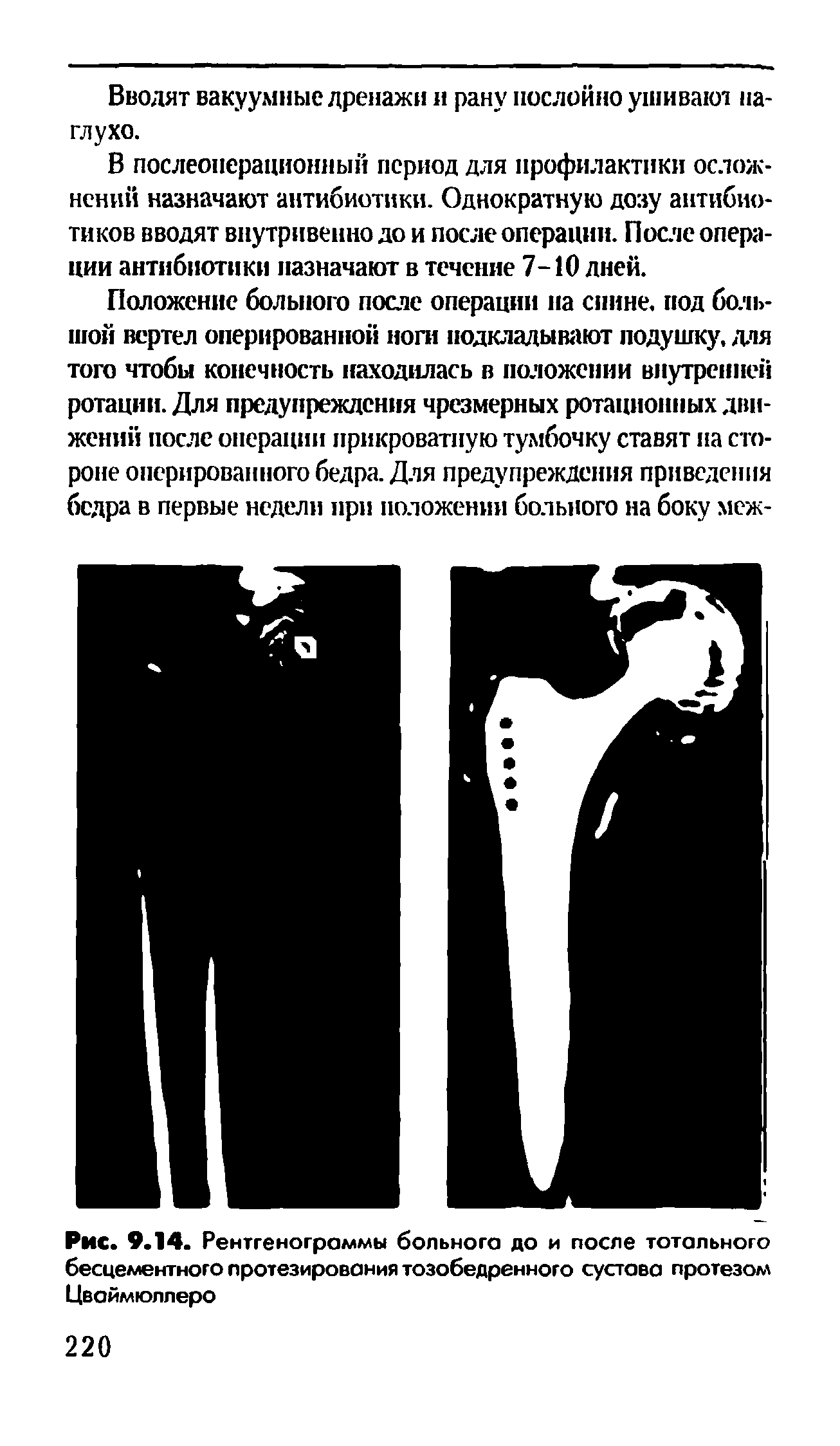 Рис. 9.14. Рентгенограммы больного до и после тотального бесцементного протезирования тазобедренного сустава протезом Цваймюллеро...