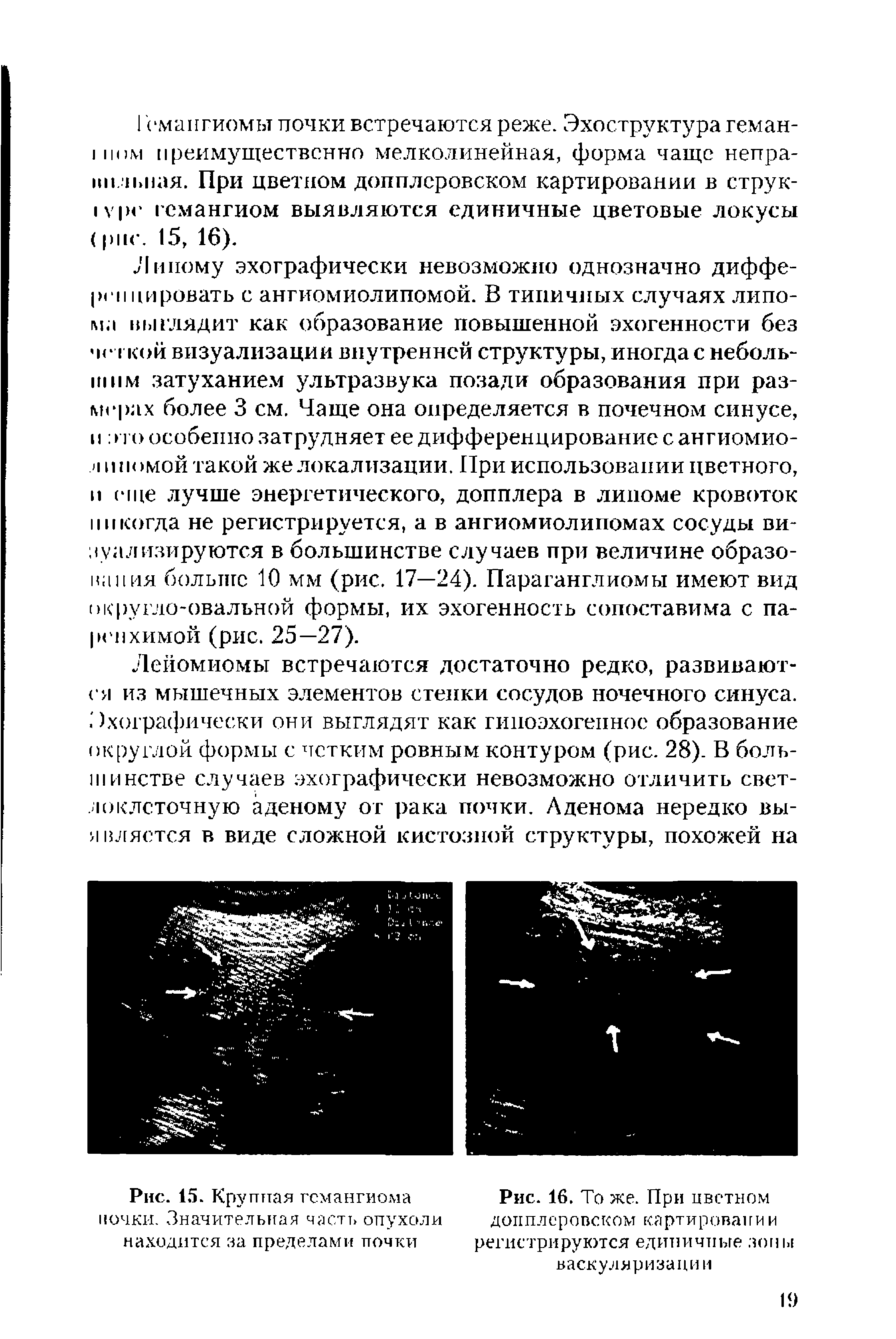 Рис. 15. Крупная гемангиома почки. Значительная часть опухоли находится за пределами почки...