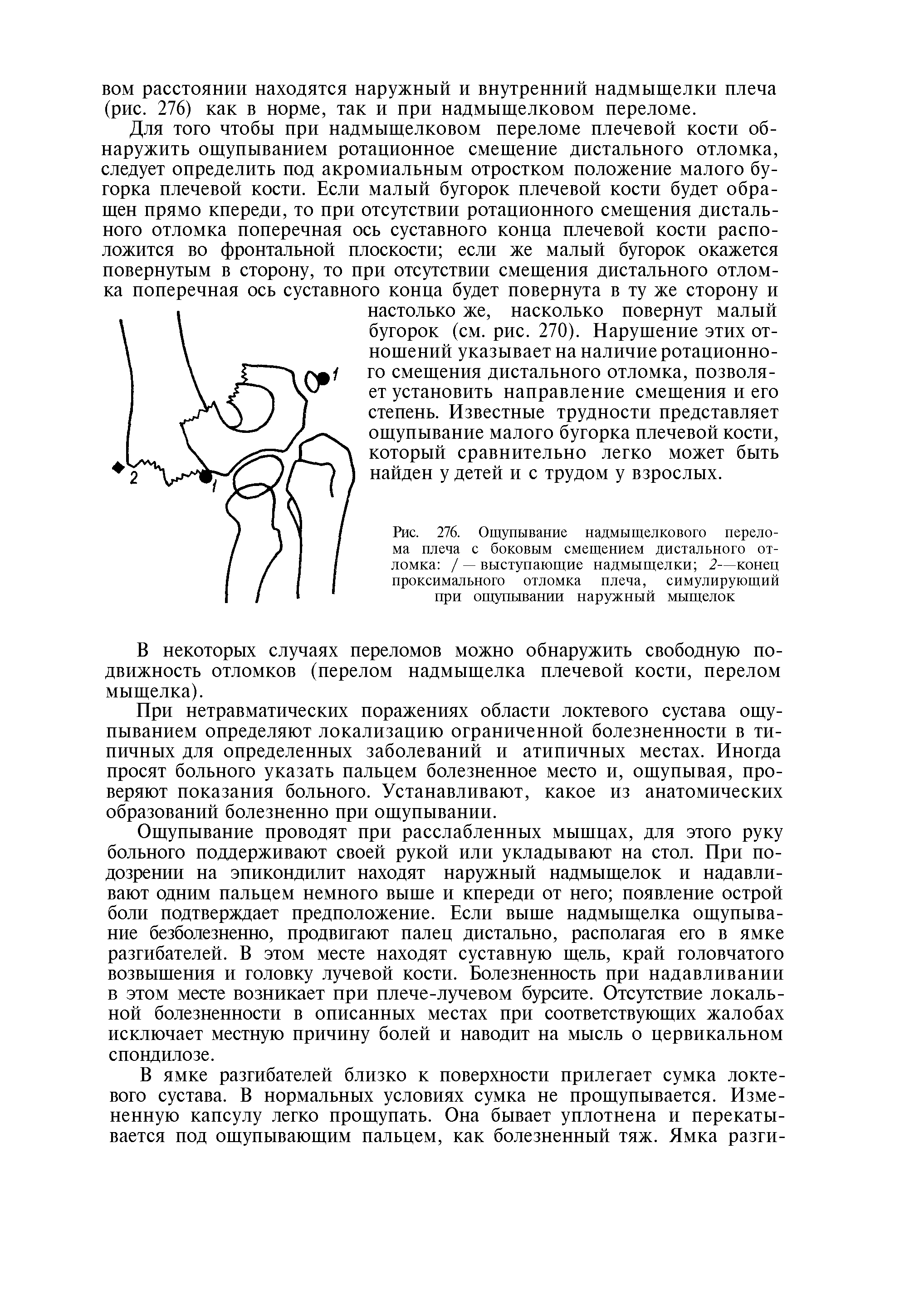 Рис. 276. Ощупывание надмыщелкового перелома плеча с боковым смещением дистального отломка / — выступающие надмыщелки 2—конец проксимального отломка плеча, симулирующий при ощупывании наружный мыщелок...