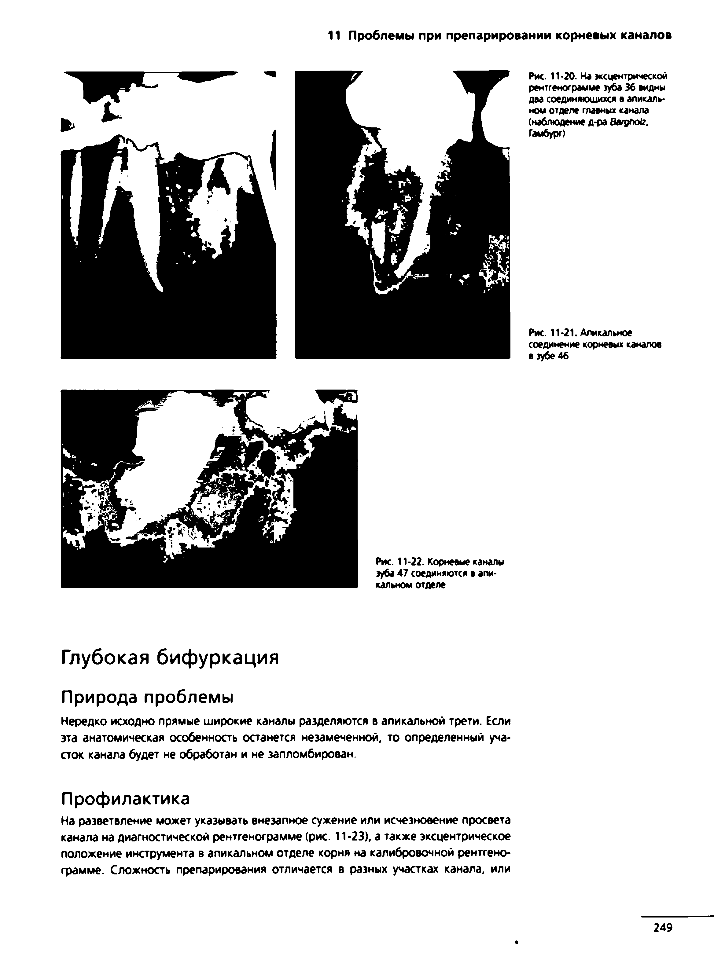 Рис. 11-20. На эксцентрической рентгенограмме зуба 36 видны два соединяющихся в апикальном отделе главных канала (наблюдение д-ра ВагдГюЬ. Гамбург)...