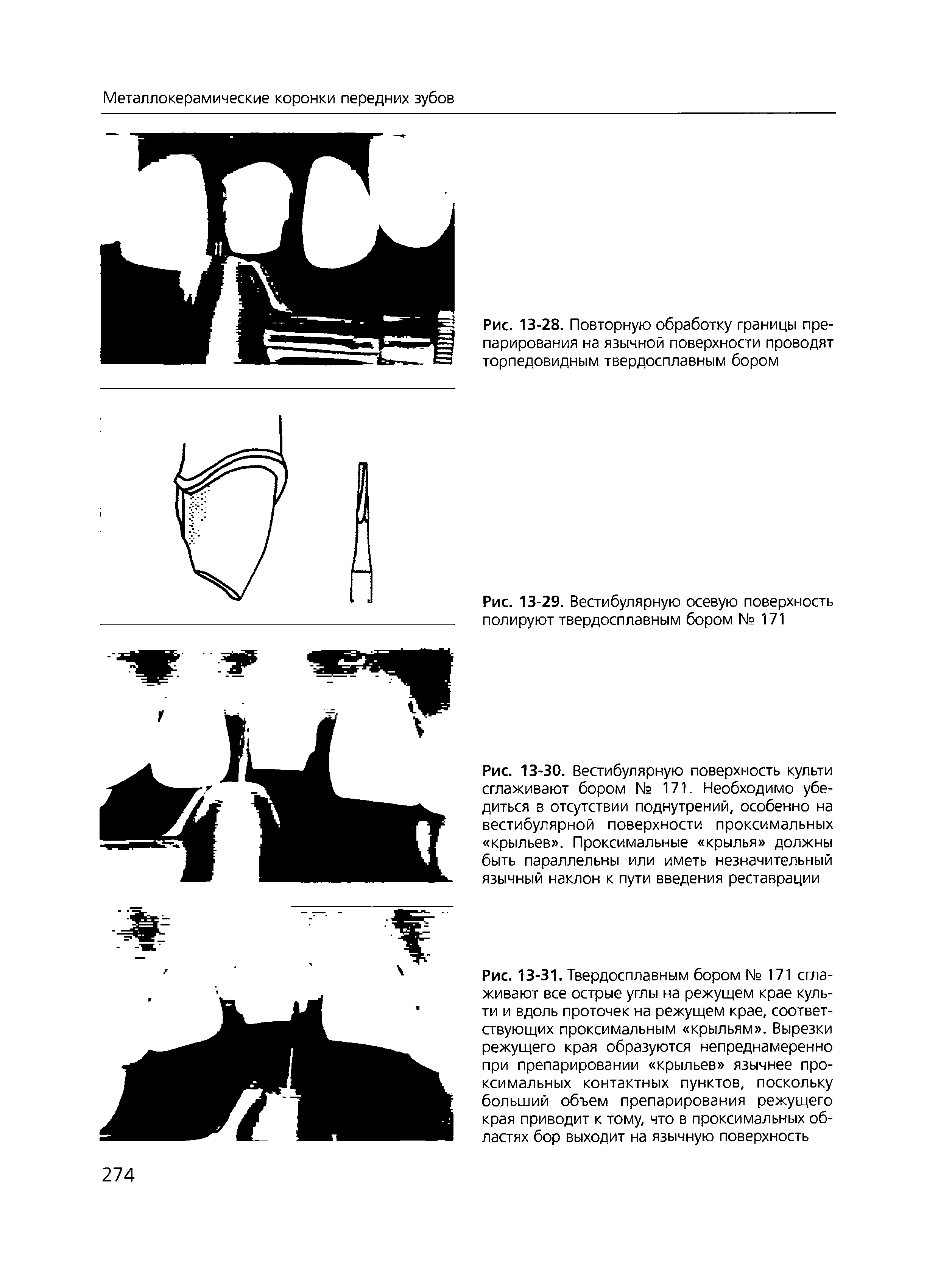 Рис. 13-30. Вестибулярную поверхность культи сглаживают бором № 171. Необходимо убедиться в отсутствии поднутрений, особенно на вестибулярной поверхности проксимальных крыльев . Проксимальные крылья должны быть параллельны или иметь незначительный язычный наклон к пути введения реставрации...
