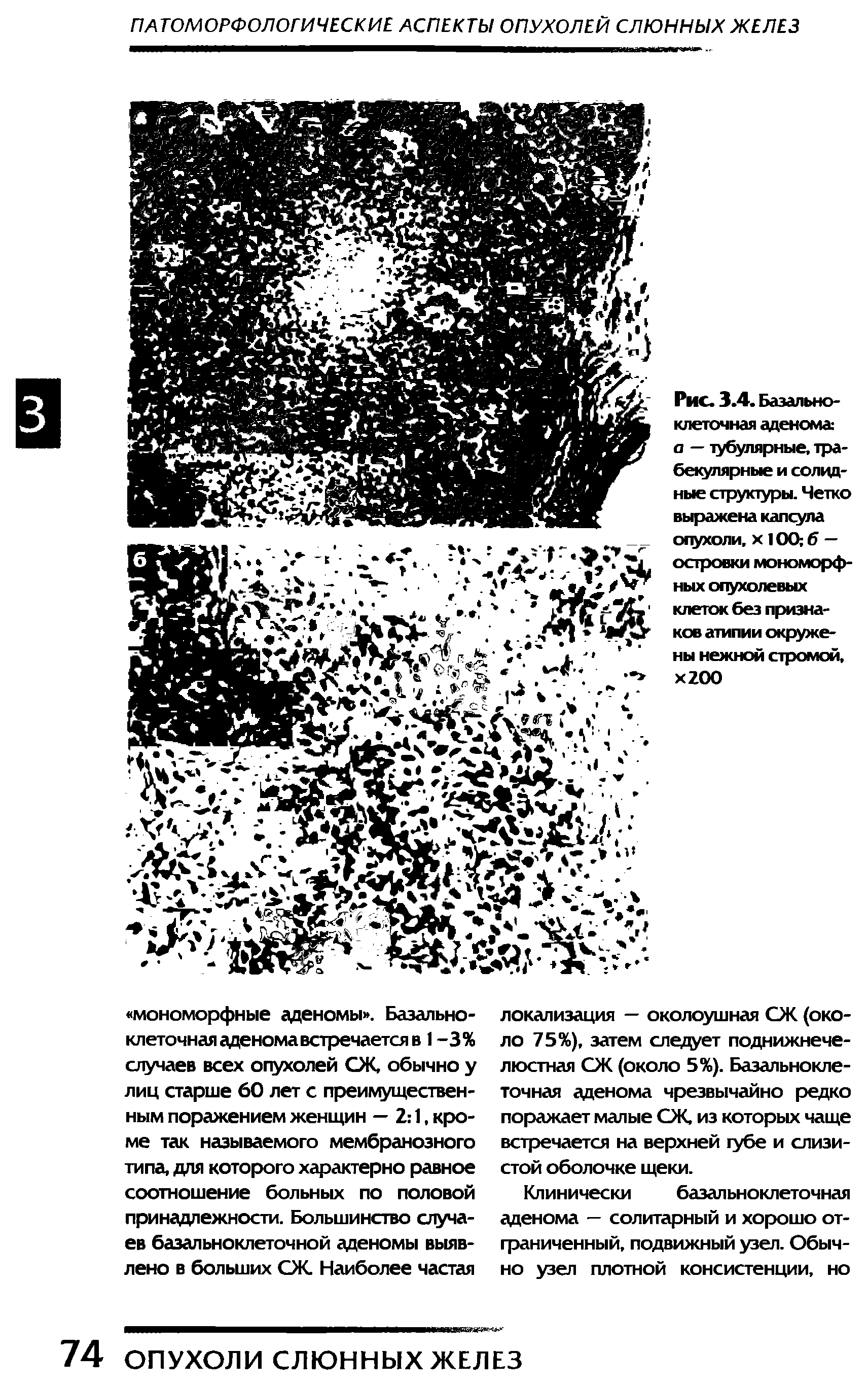 Рис. 3.4. Базальноклеточная аденома а — тубулярные, трабекулярные и солидные структуры. Четко выражена капсула опухоли, х 10О б — островки мономорфных опухолевых клеток без признаков атипии окружены нежной стромой, х200...