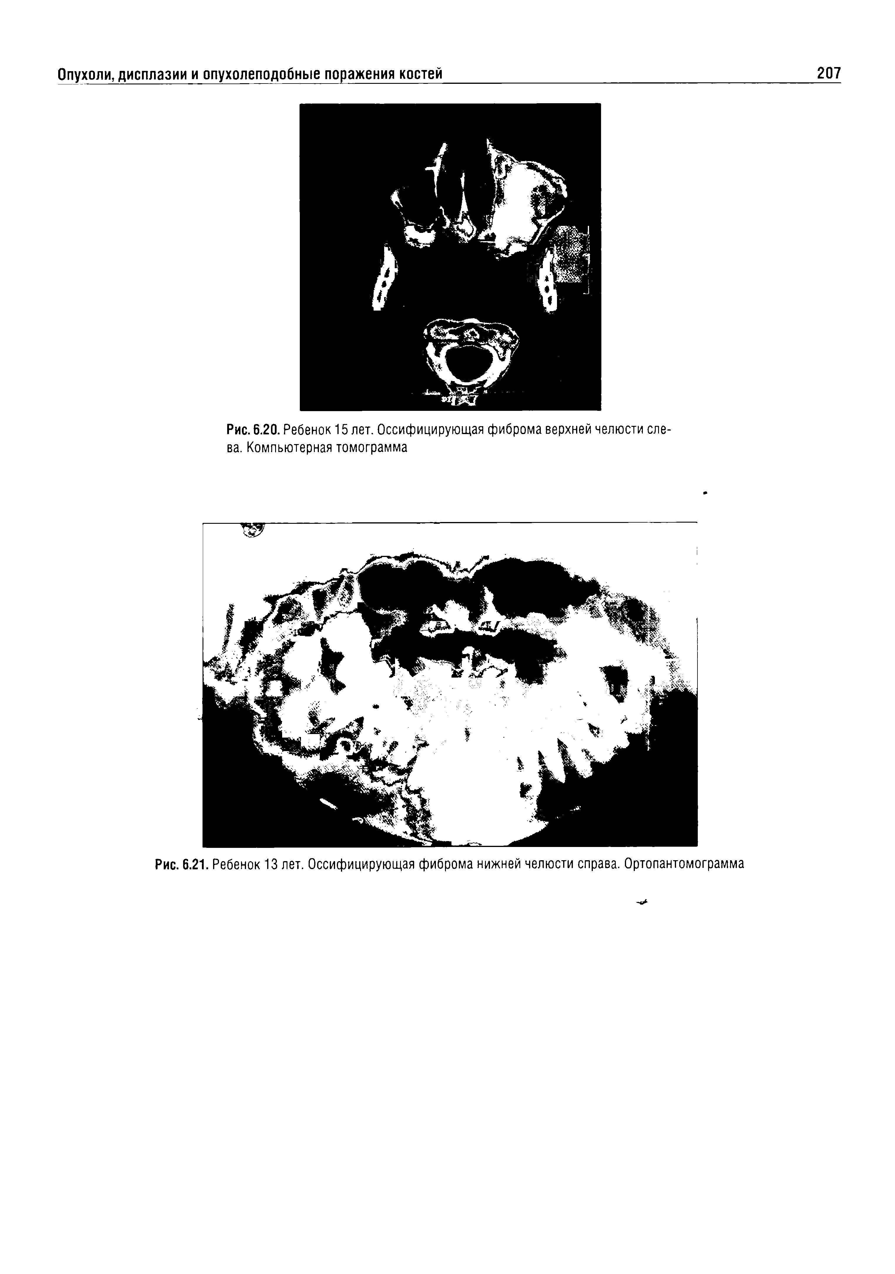 Рис. 6.21. Ребенок 13 лет. Оссифицирующая фиброма нижней челюсти справа. Ортопантомограмма...