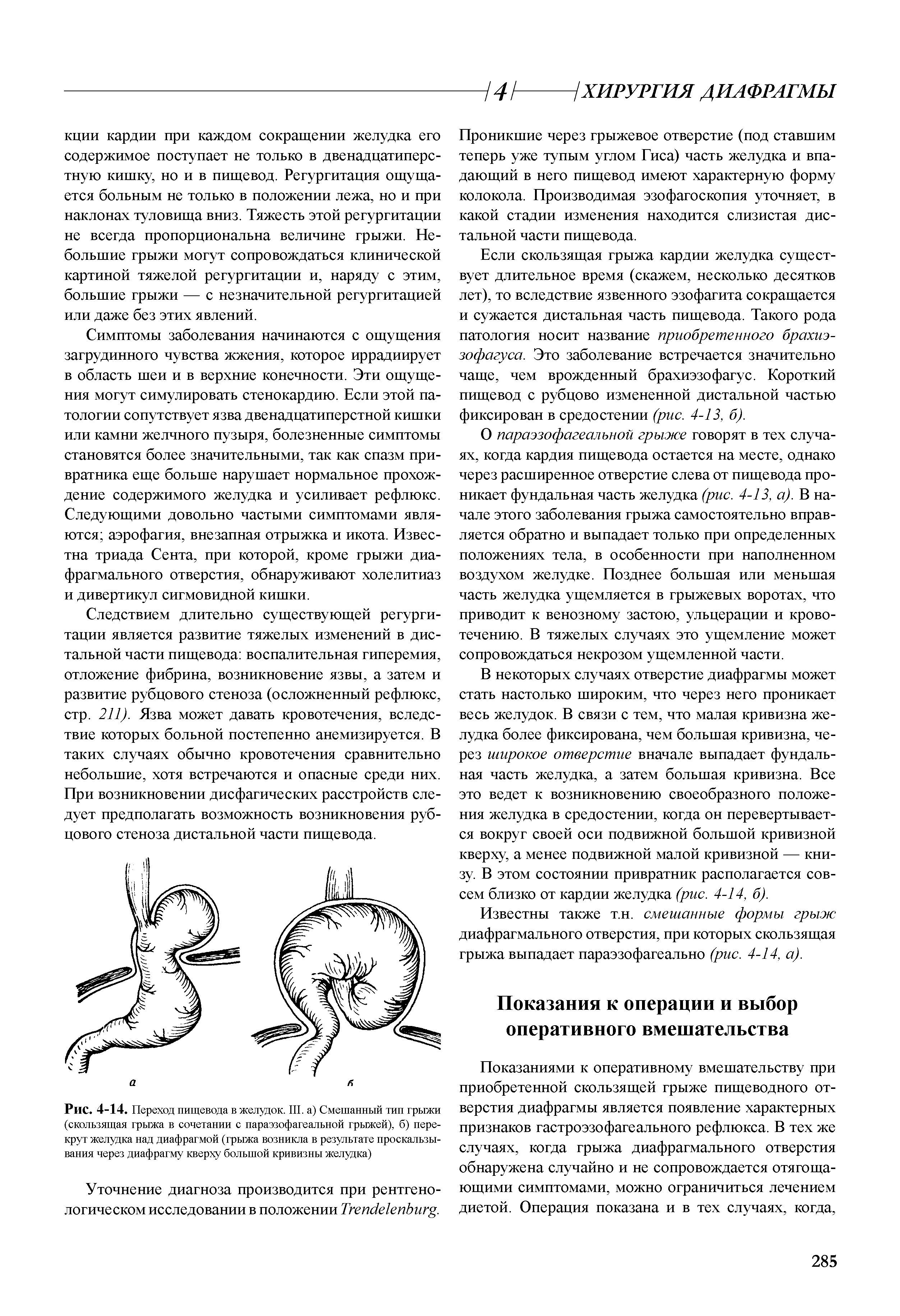 Рис. 4-14. Переход пищевода в желудок. III. а) Смешанный тип грыжи (скользящая грыжа в сочетании с параэзофагеальной грыжей), б) пере-крут желудка над диафрагмой (грыжа возникла в результате проскальзывания через диафрагму кверху большой кривизны желудка)...