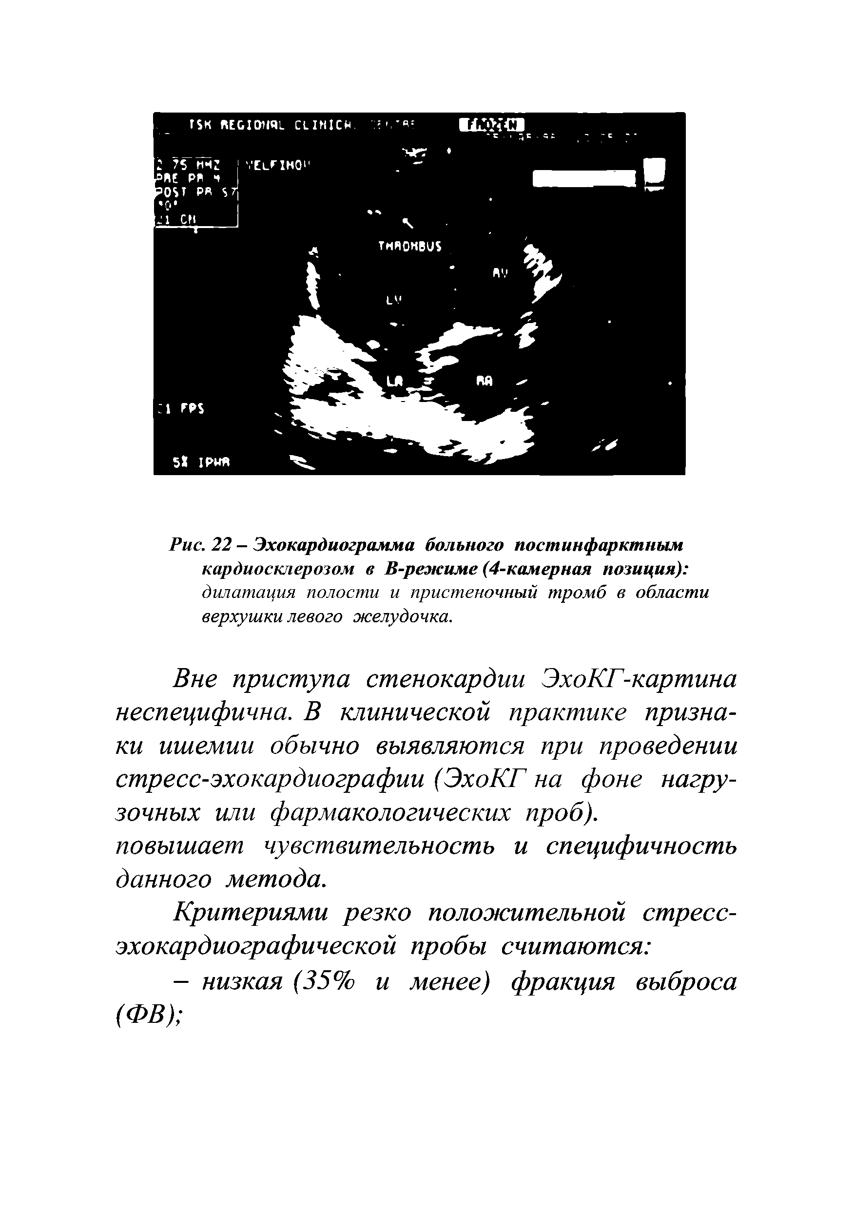 Рис. 22 - Эхокардиограмма больного постинфарктным кардиосклерозом в В-режиме (4-камерная позиция) дилатация полости и пристеночный тромб в области верхушки левого желудочка.