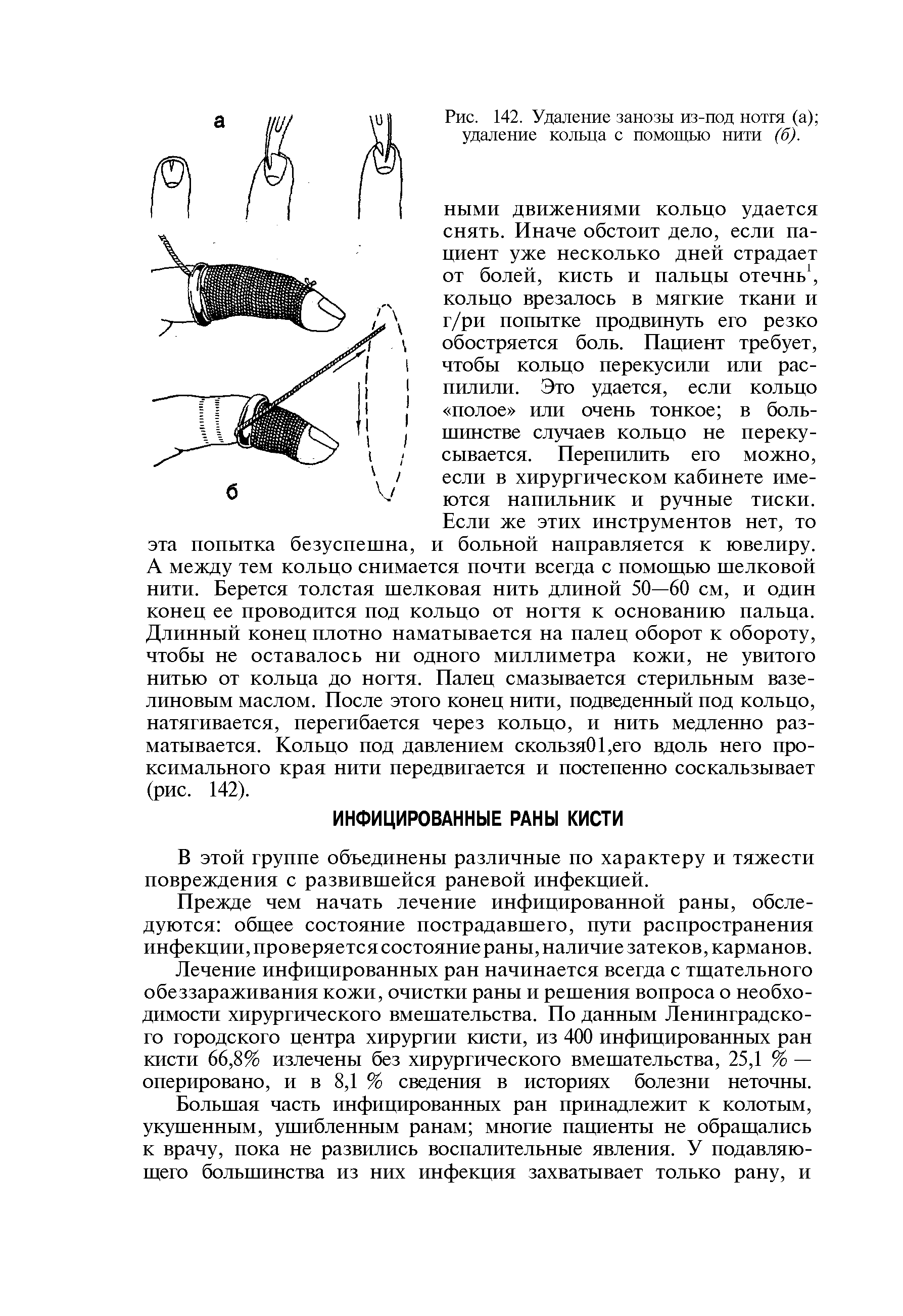 Рис. 142. Удаление занозы из-под нотгя (а) удаление кольца с помощью нити (б).