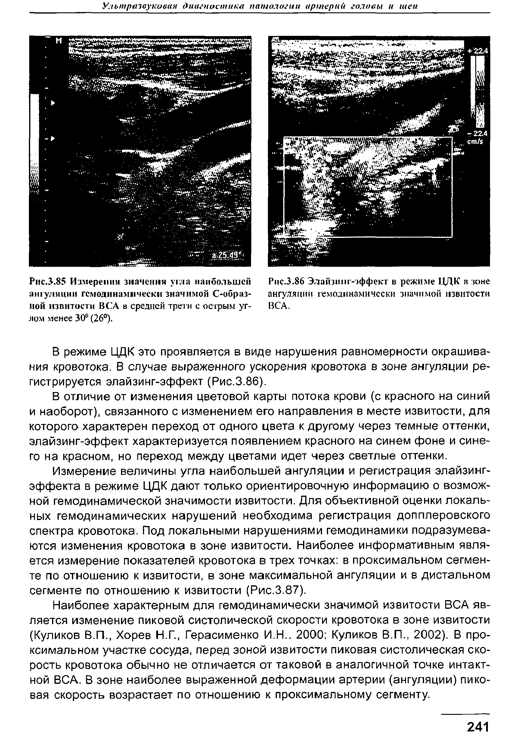 Рис.3.86 Элайзинг-эффект в режиме ЦДК в зоне ангуляции гемодинамичсски значимой извитости ВСА.