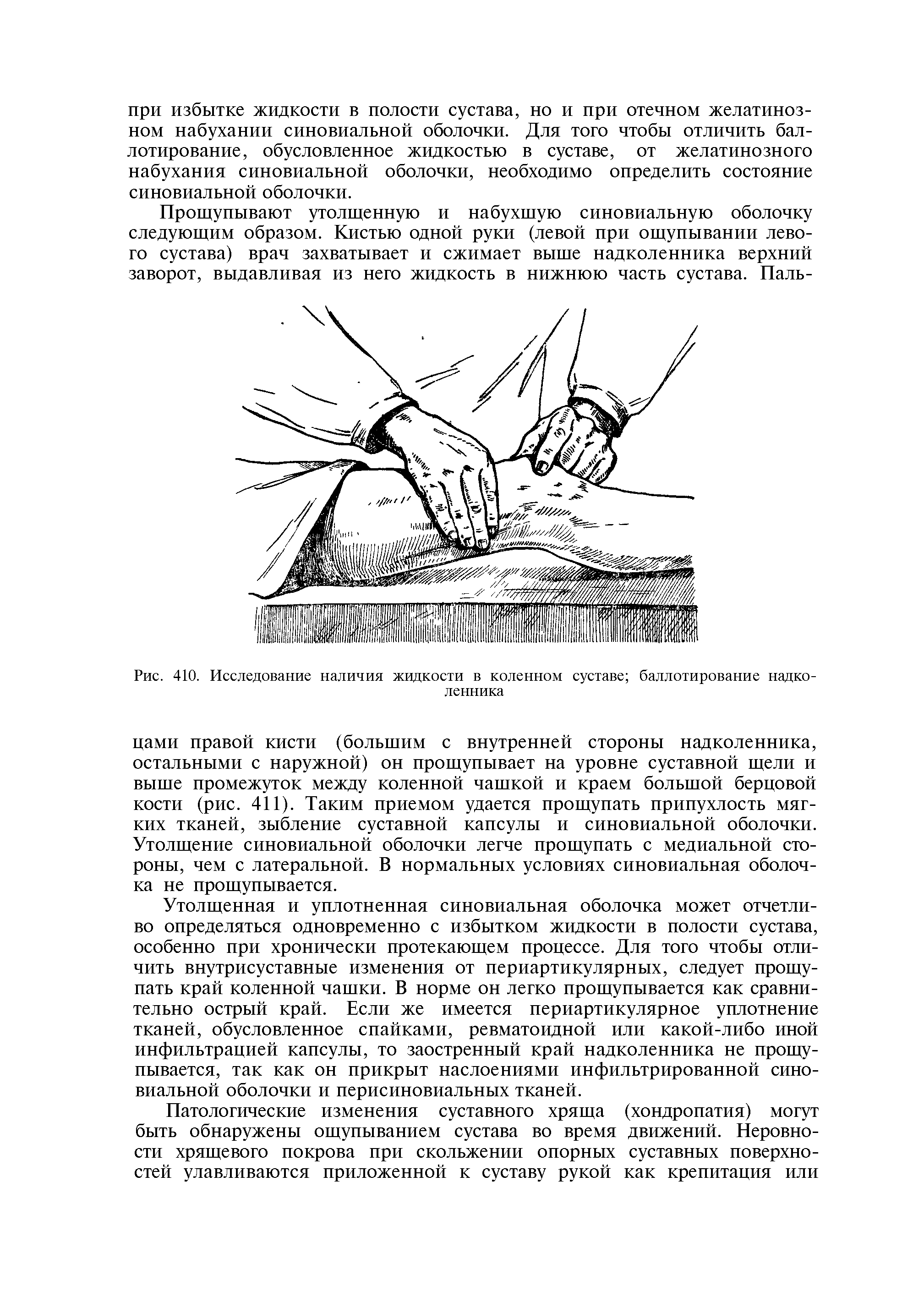 Рис. 410. Исследование наличия жидкости в коленном суставе баллотирование надколенника...