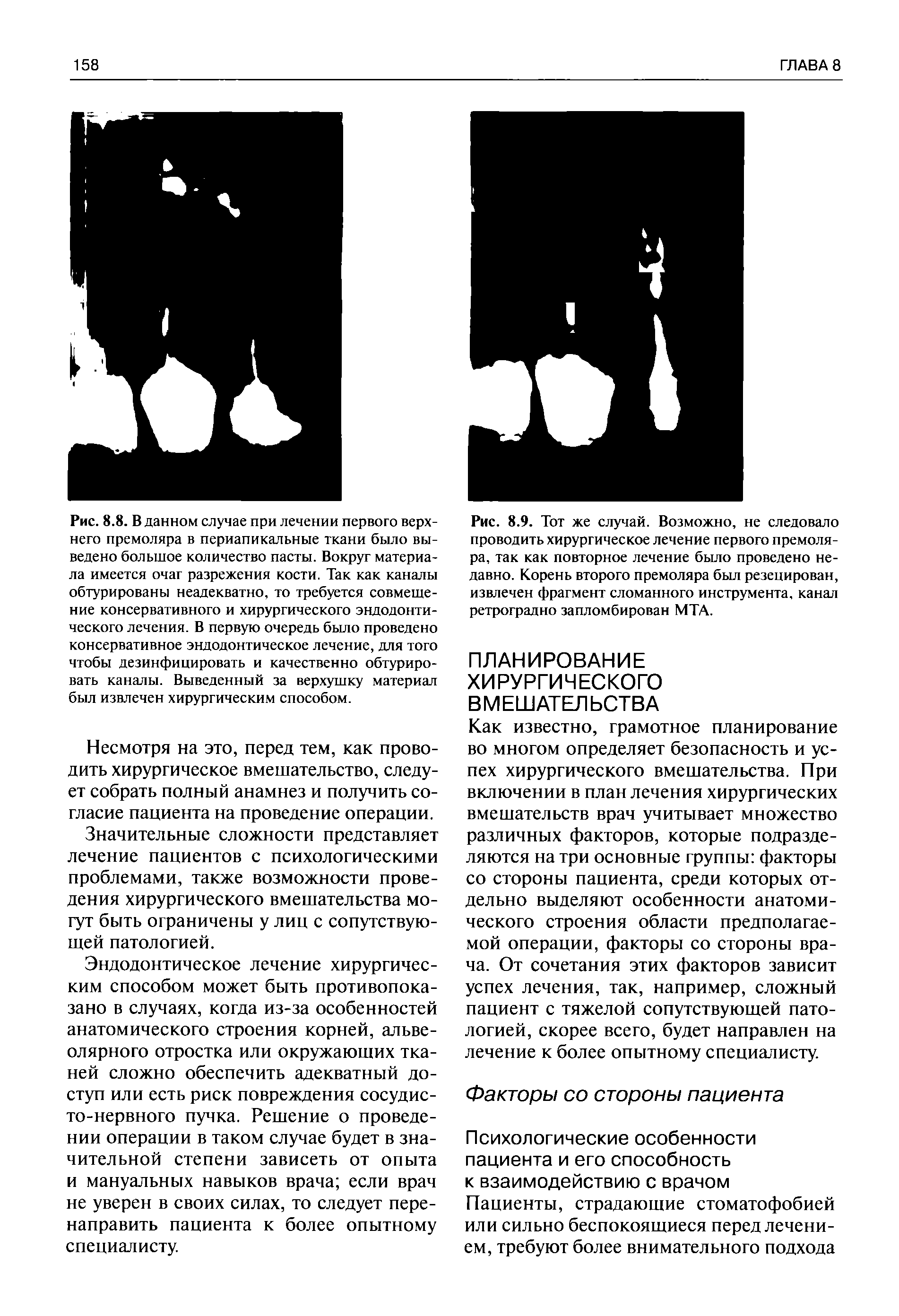 Рис. 8.9. Тот же случай. Возможно, не следовало проводить хирургическое лечение первого премоляра, так как повторное лечение было проведено недавно. Корень второго премоляра был резецирован, извлечен фрагмент сломанного инструмента, канал ретроградно запломбирован МТА.