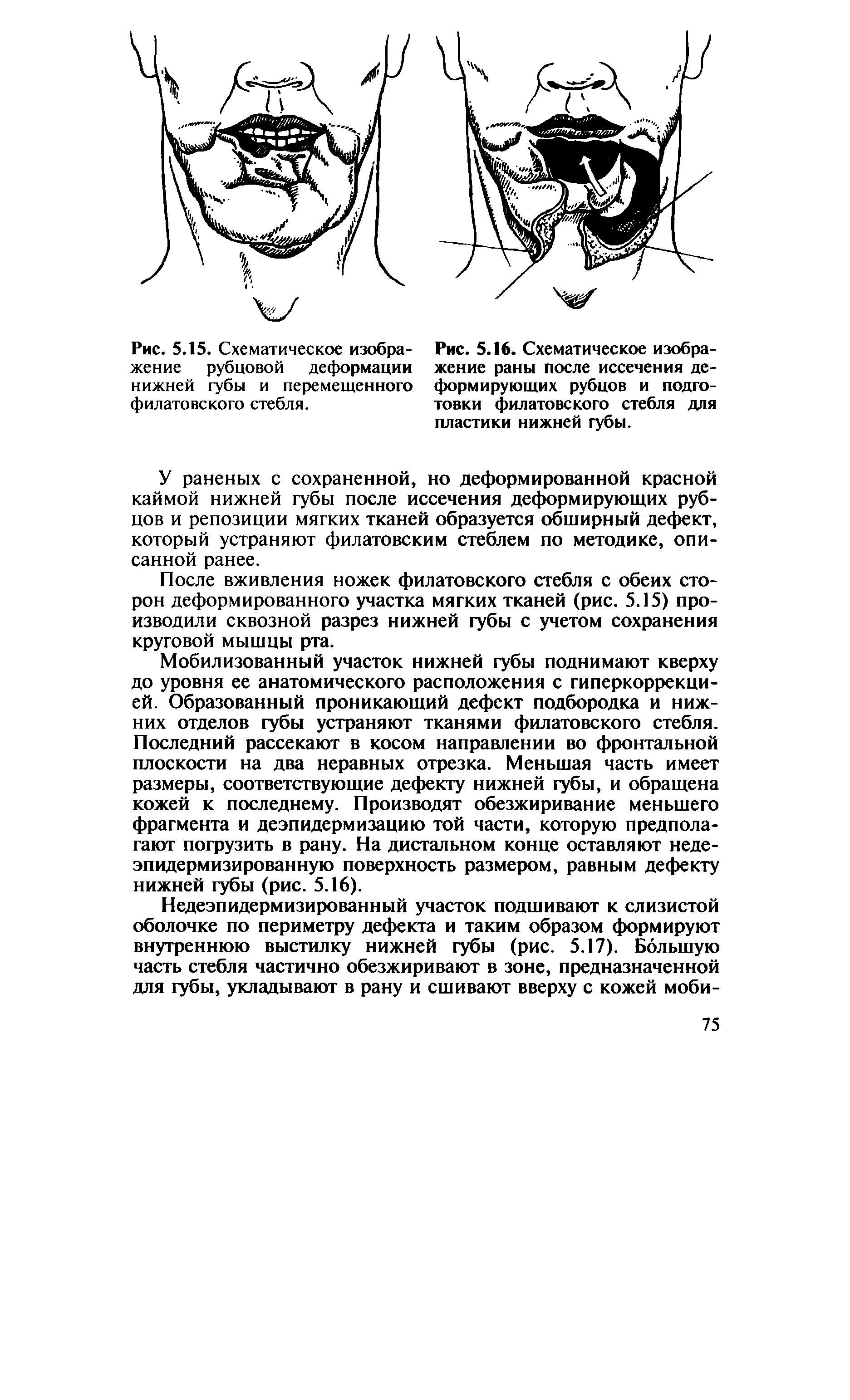 Рис. 5.15. Схематическое изображение рубцовой деформации нижней губы и перемещенного филатовского стебля.