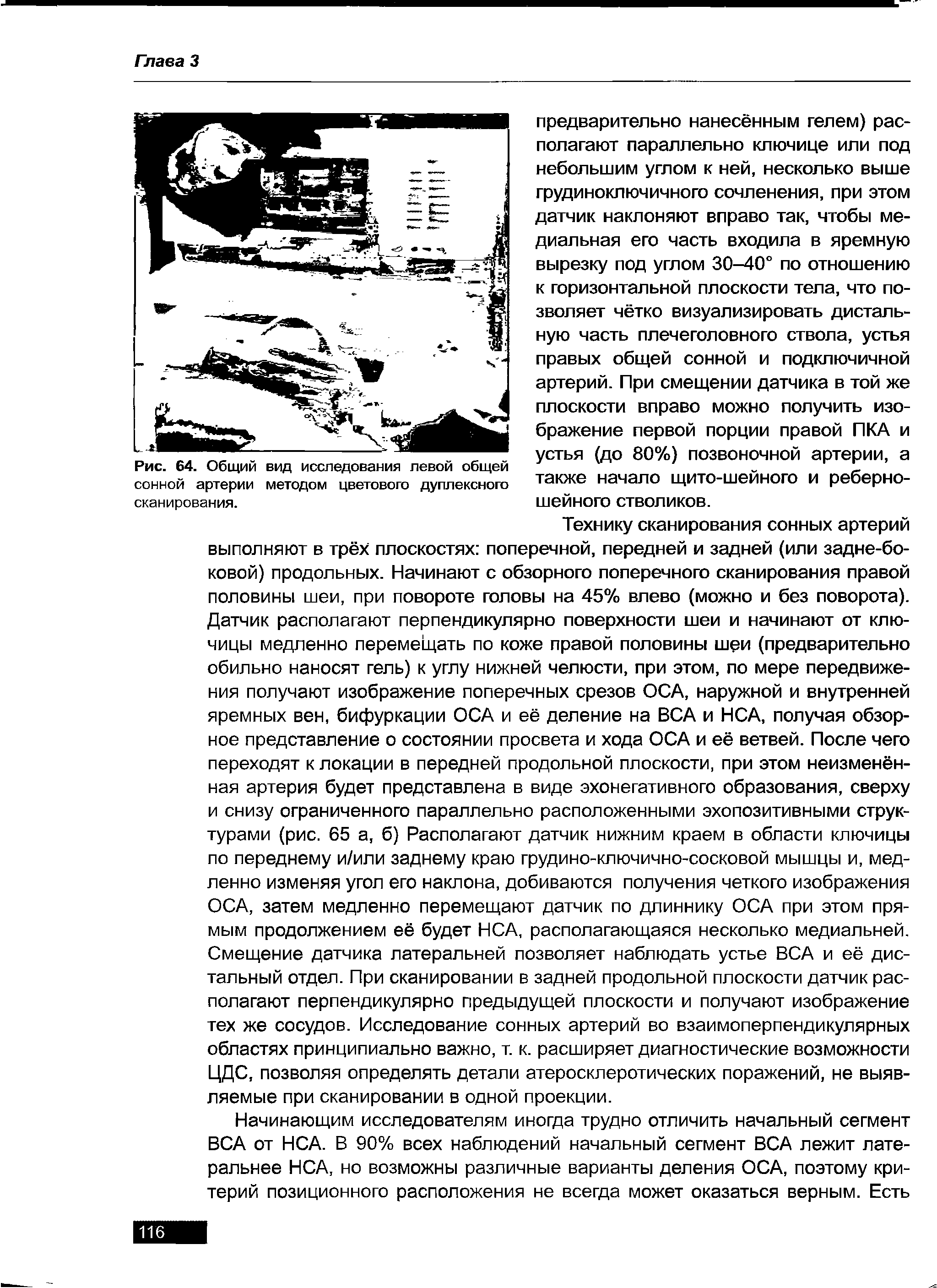 Рис. 64. Общий вид исследования левой общей сонной артерии методом цветового дуплексного сканирования.