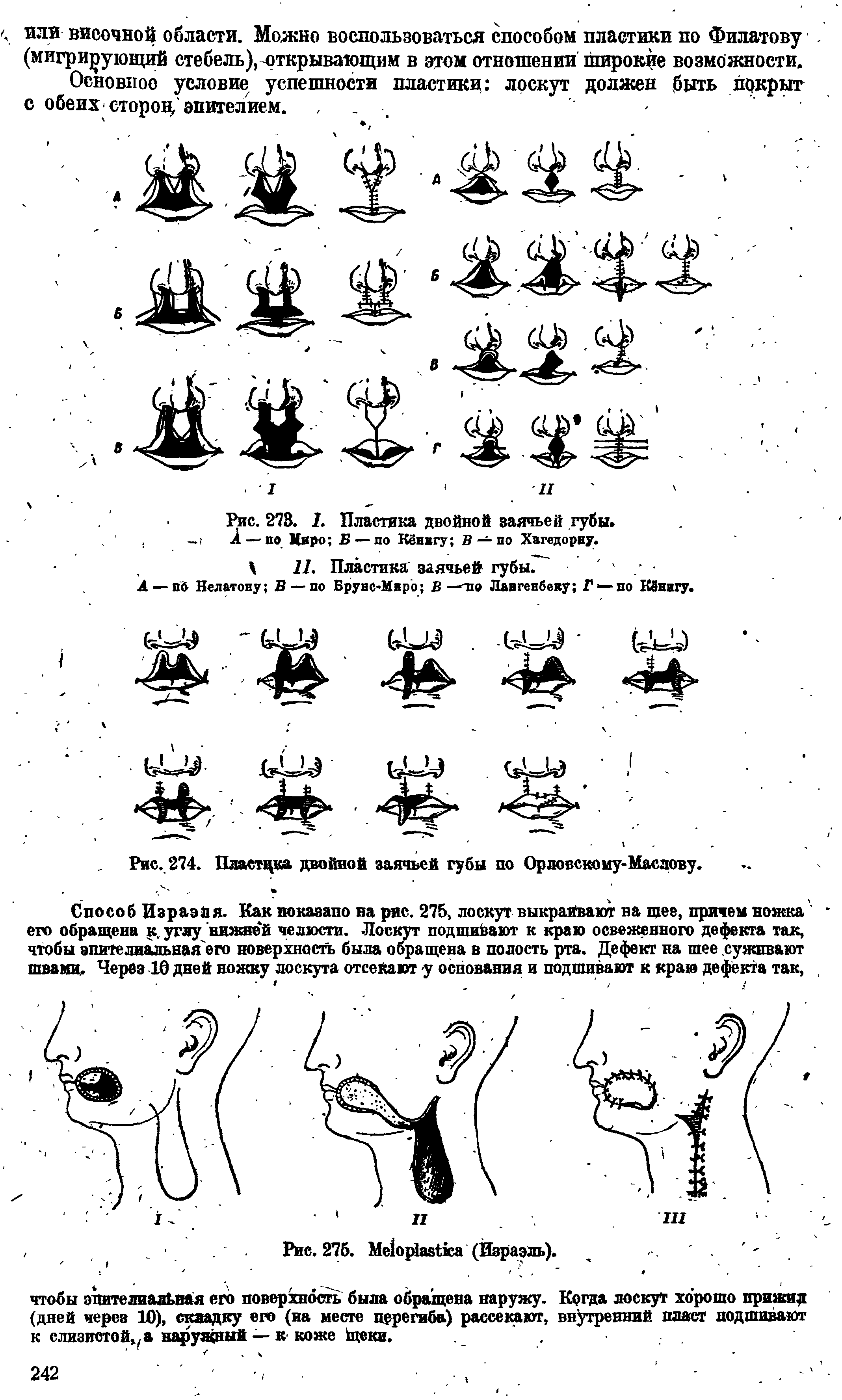 Рис. 273. /. Пластика двойной заячьей губы. А —- по Миро Б — по Кёнвгу В —по Хагедорну.
