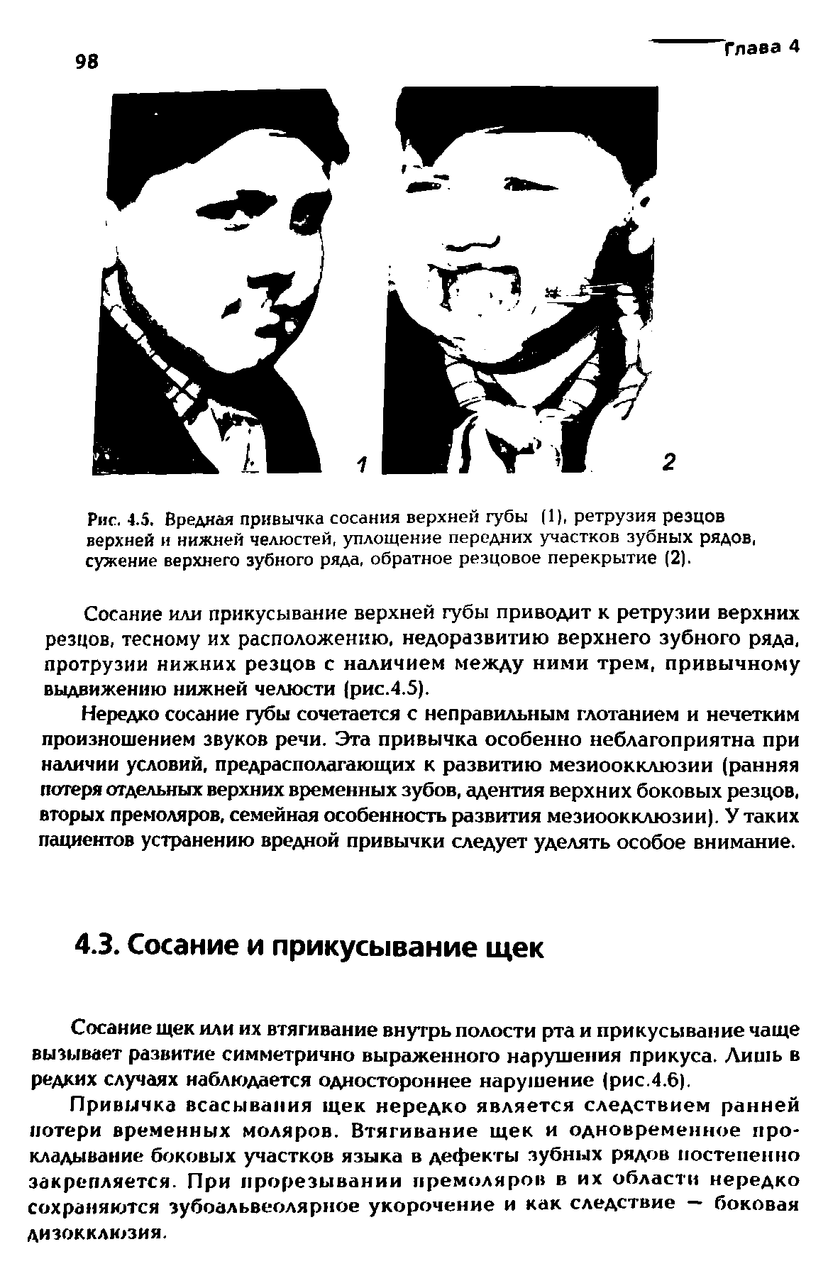 Рис. 4.5. Вредная привычка сосания верхней губы (1), ретрузия резцов верхней и нижней челюстей, уплощение передних участков зубных рядов, сужение верхнего зубного ряда, обратное резцовое перекрытие (2).