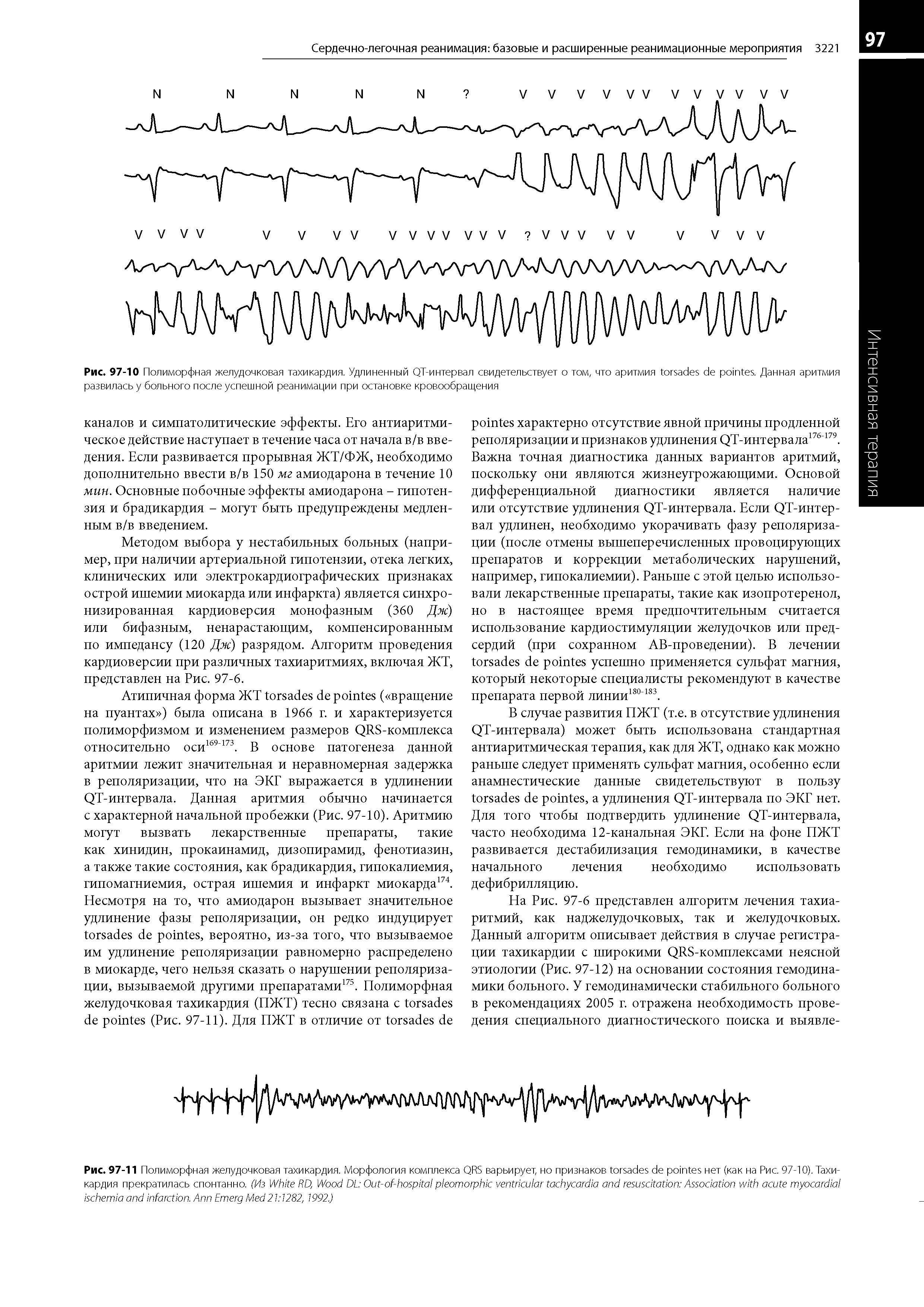 Рис. 97-10 Полиморфная желудочковая тахикардия. Удлиненный QT-интервал свидетельствует о том, что аритмия . Данная аритмия развилась у больного после успешной реанимации при остановке кровообращения...