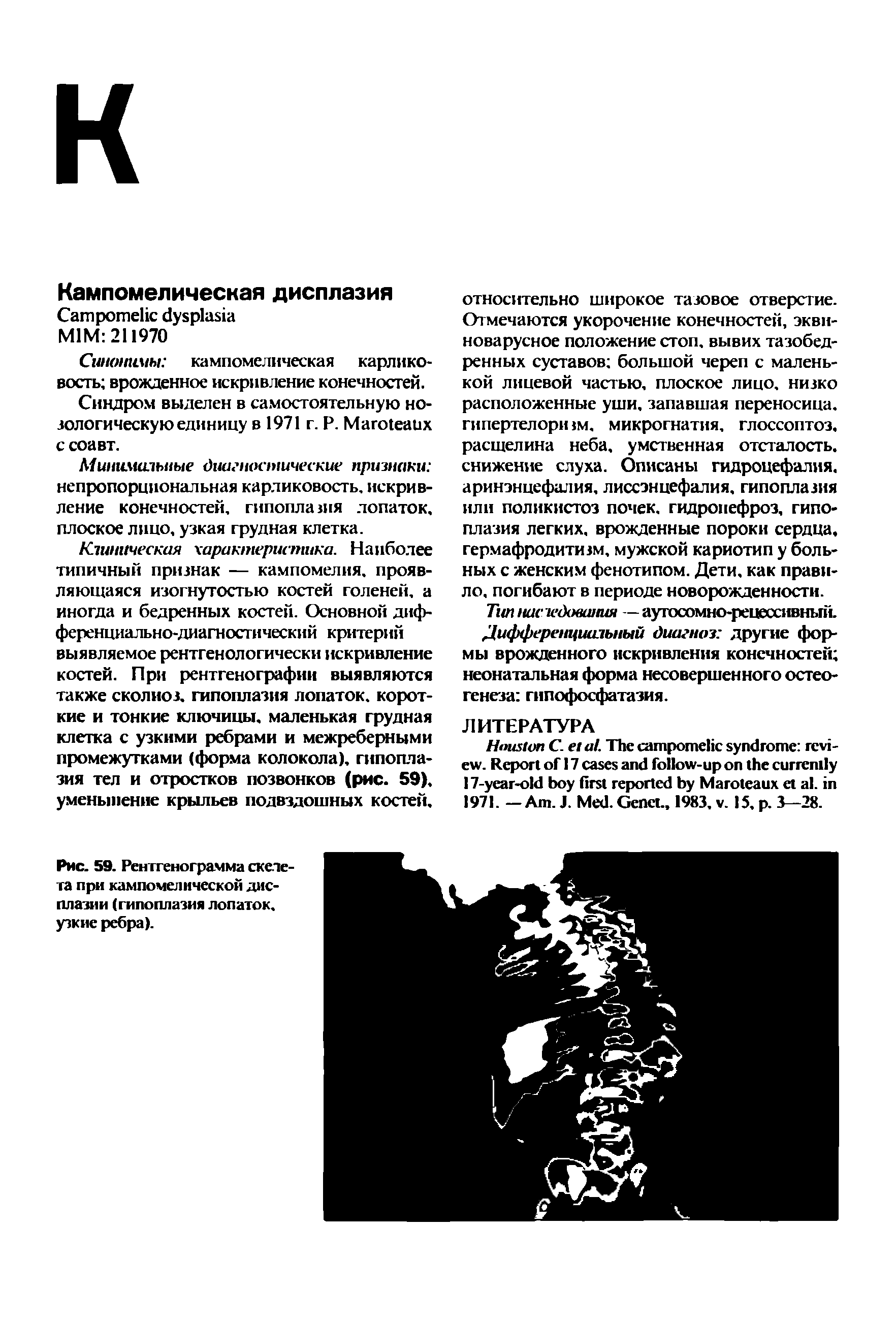 Рис. 59. Рентгенограмма скелета при кампомелической дисплазии (гипоплазия лопаток, узкие ребра).