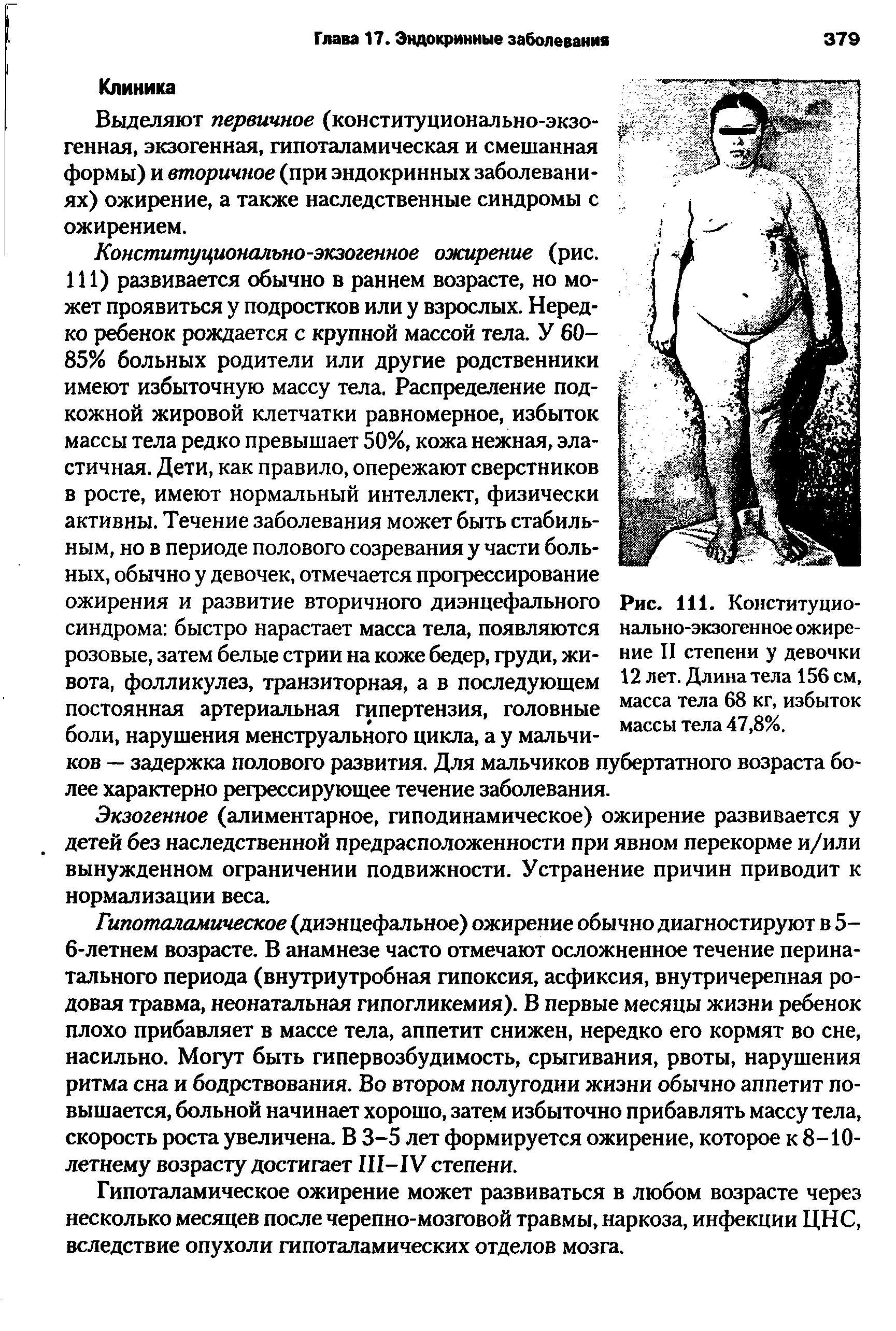 Рис. 111. Конституционально-экзогенное ожирение II степени у девочки 12 лет. Длина тела 156 см, масса тела 68 кг, избыток массы тела 47,8%.