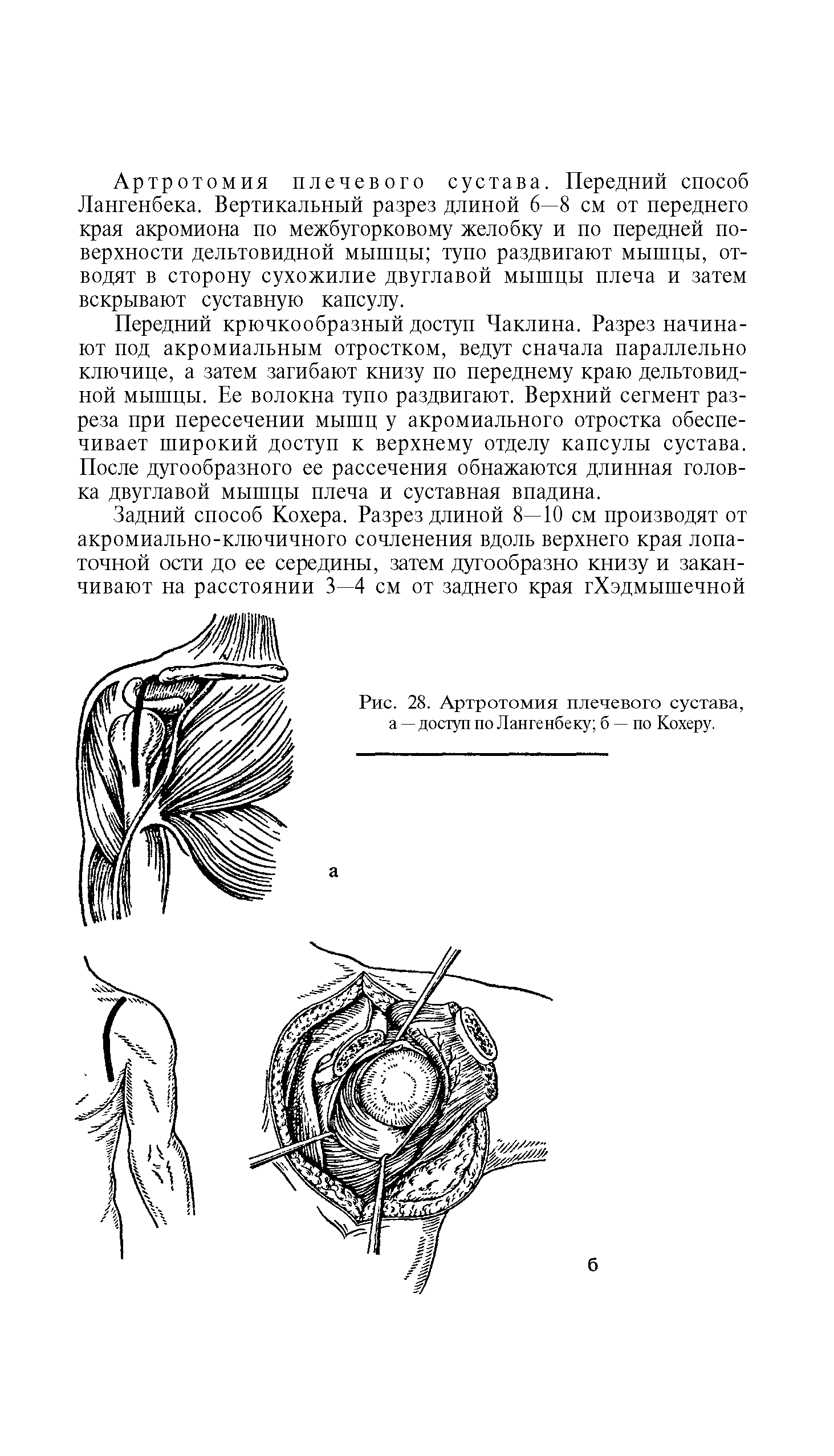 Рис. 28. Артротомия плечевого сустава, а — доступ по Ланге нбеку б — по Кохеру.