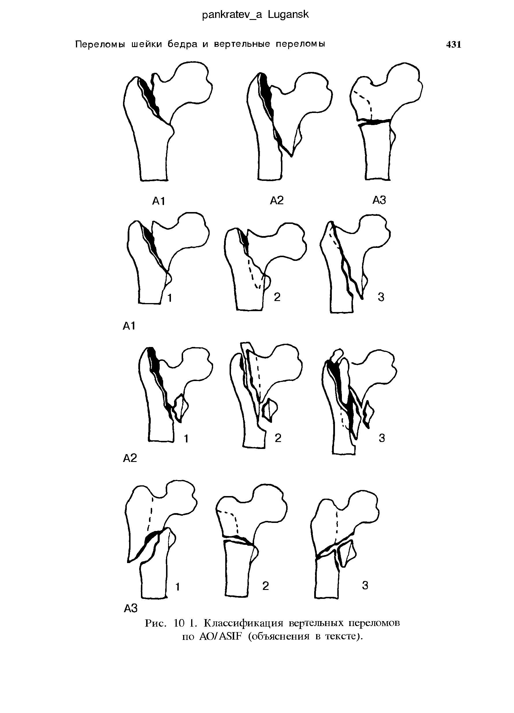 Рис. 10 1. Классификация вертельных переломов по АО/ASIF (объяснения в тексте).