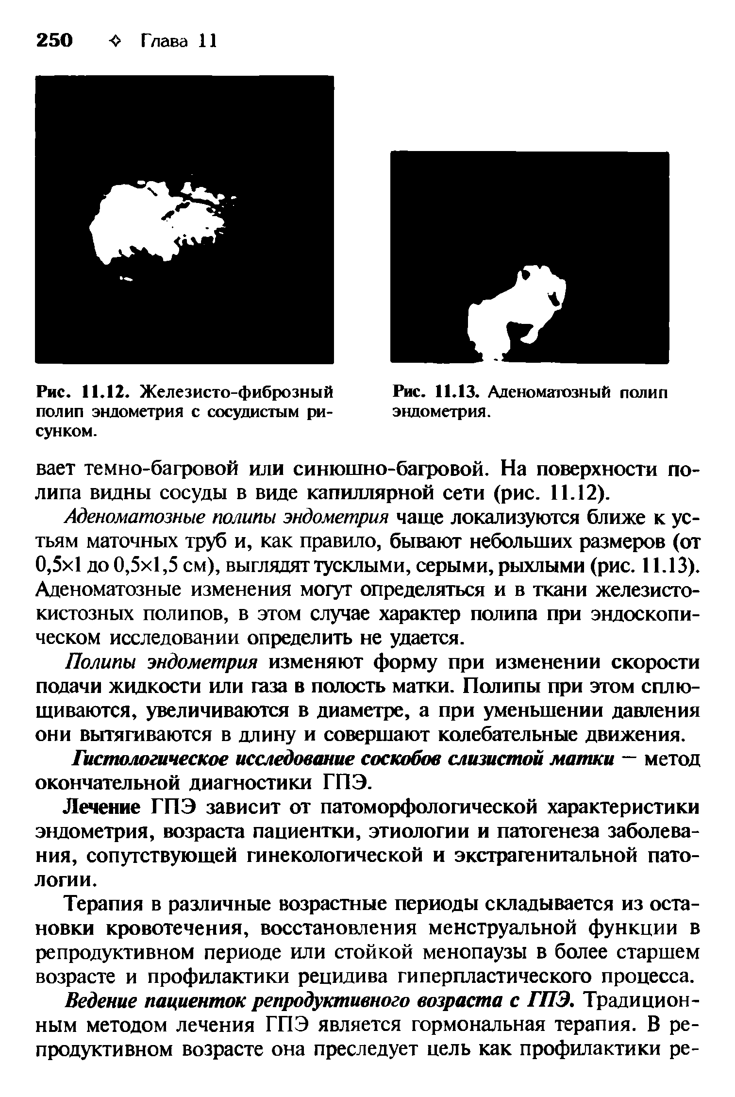 Рис. 11.12. Железисто-фиброзный полип эндометрия с сосудистым рисунком.