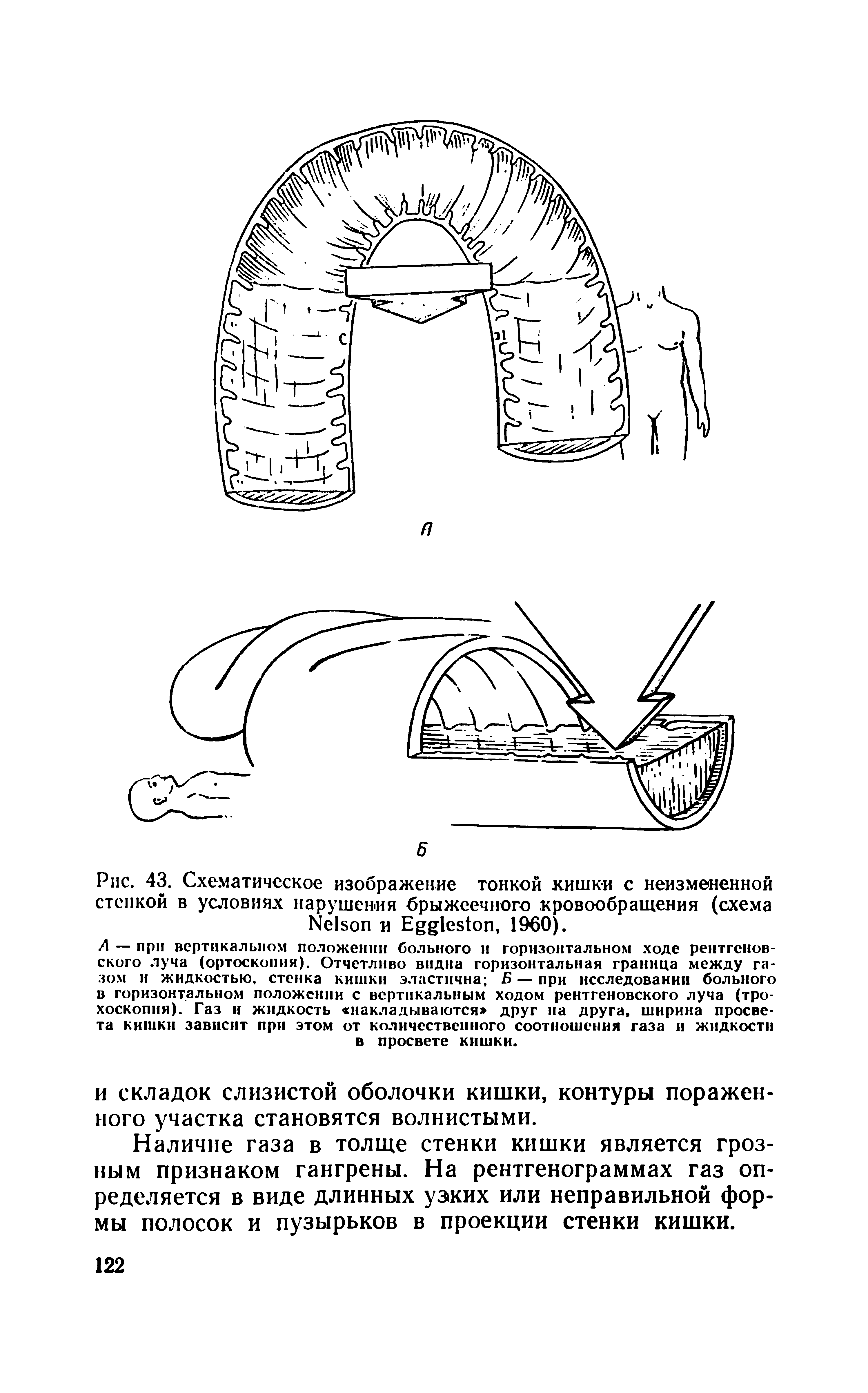 Рис. 43. Схематическое изображение тонкой кишки с неизмененной стенкой в условиях нарушения брыжеечного кровообращения (схема N и E , I960).