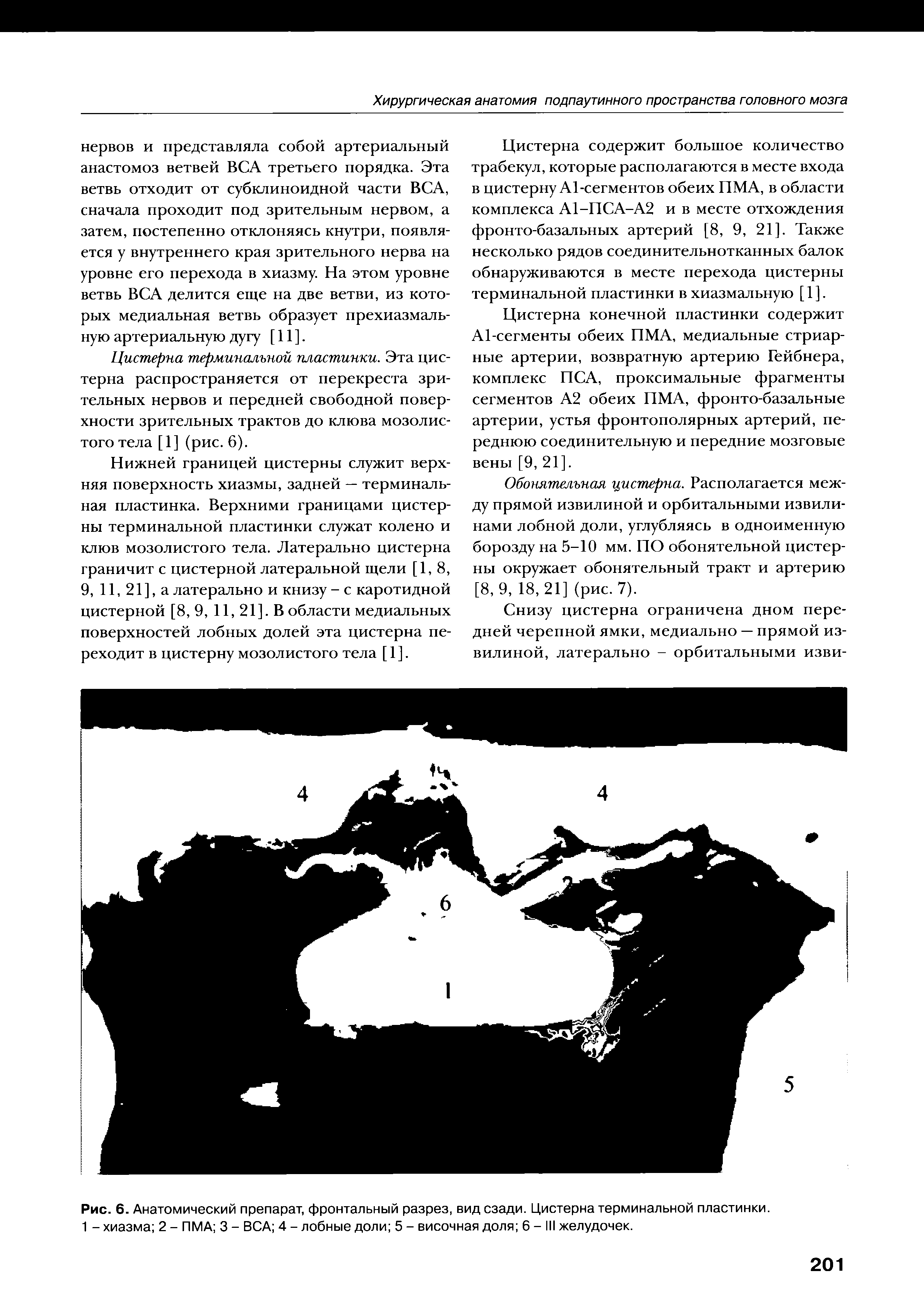 Рис. 6. Анатомический препарат, фронтальный разрез, вид сзади. Цистерна терминальной пластинки. 1 - хиазма 2 - ПМА 3 - ВСА 4 - лобные доли 5 - височная доля 6 - III желудочек.